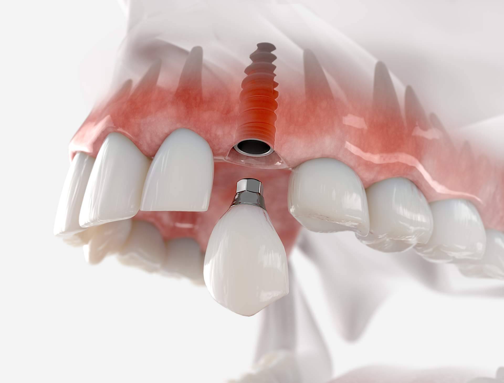 ¿Cuáles son las consecuencias de la pérdida de un diente?, por Dentinova