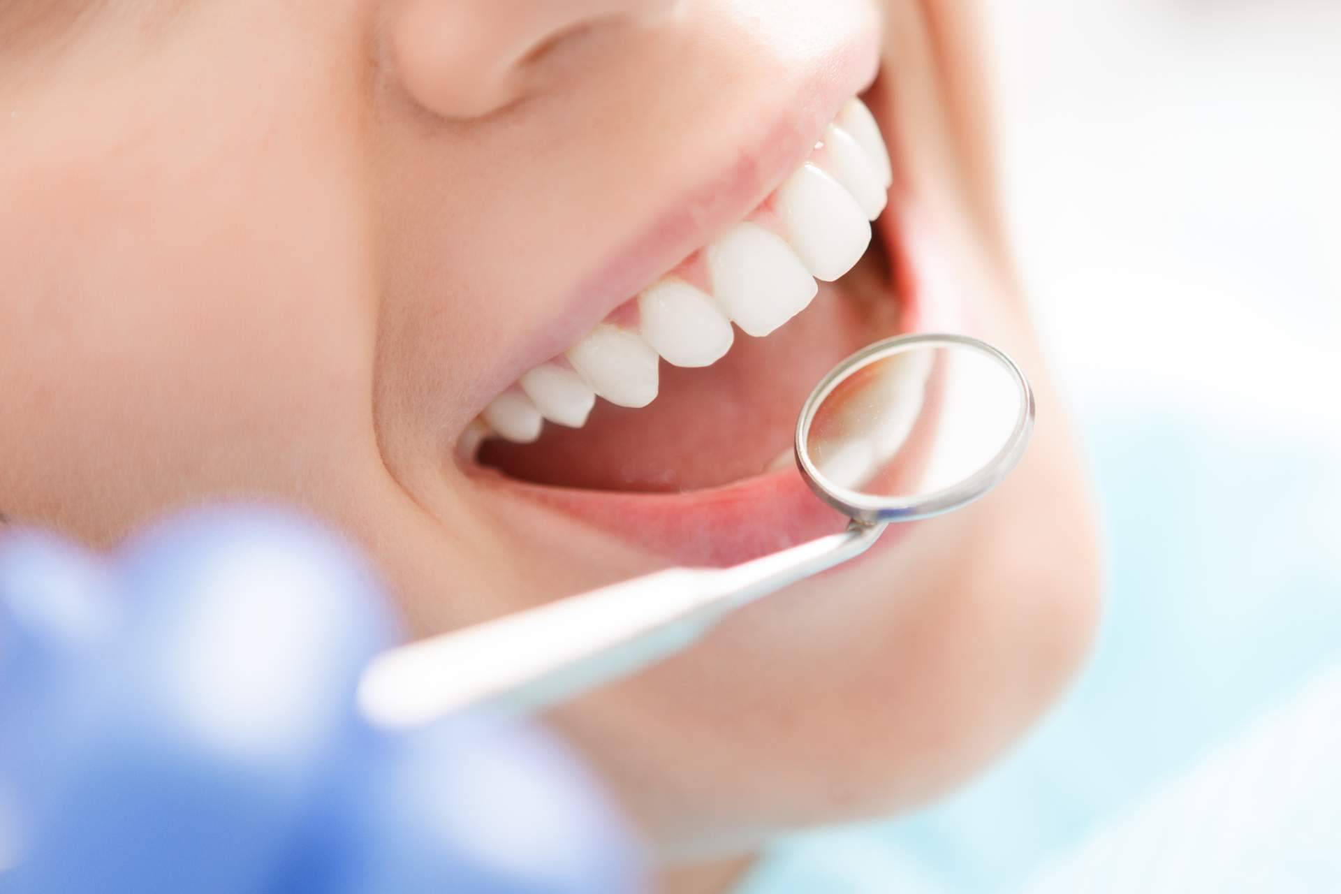 ¿En qué consiste el blanqueamiento dental?, por Bucalia