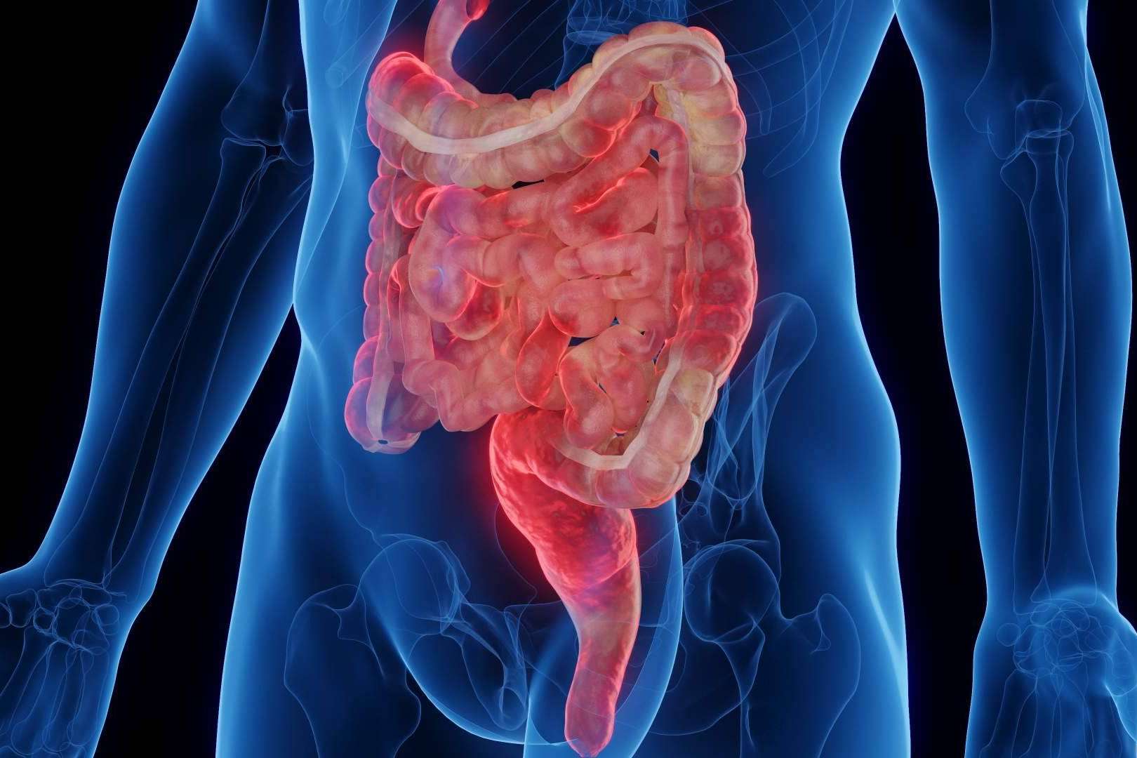 ¿Qué es la enfermedad de Crohn?
