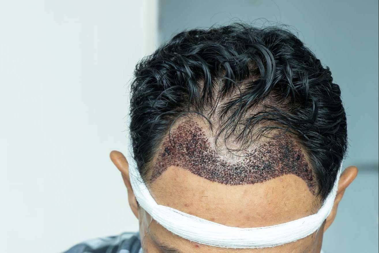 El éxito de un injerto capilar depende de su buen diseño, por MC360
