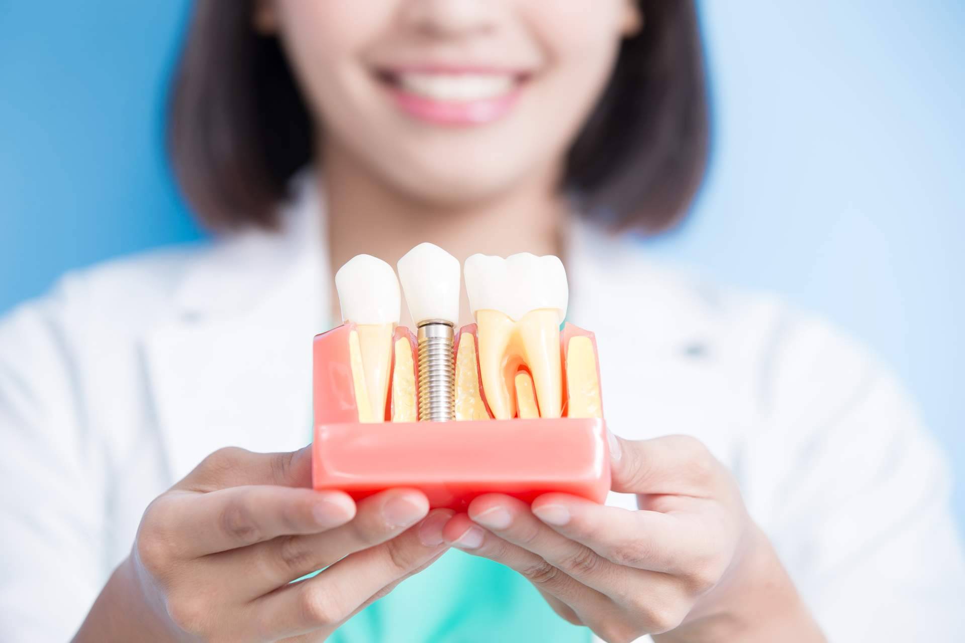 Los tipos de implantes dentales que existen y cuál usar según las necesidades, por DeltaDent