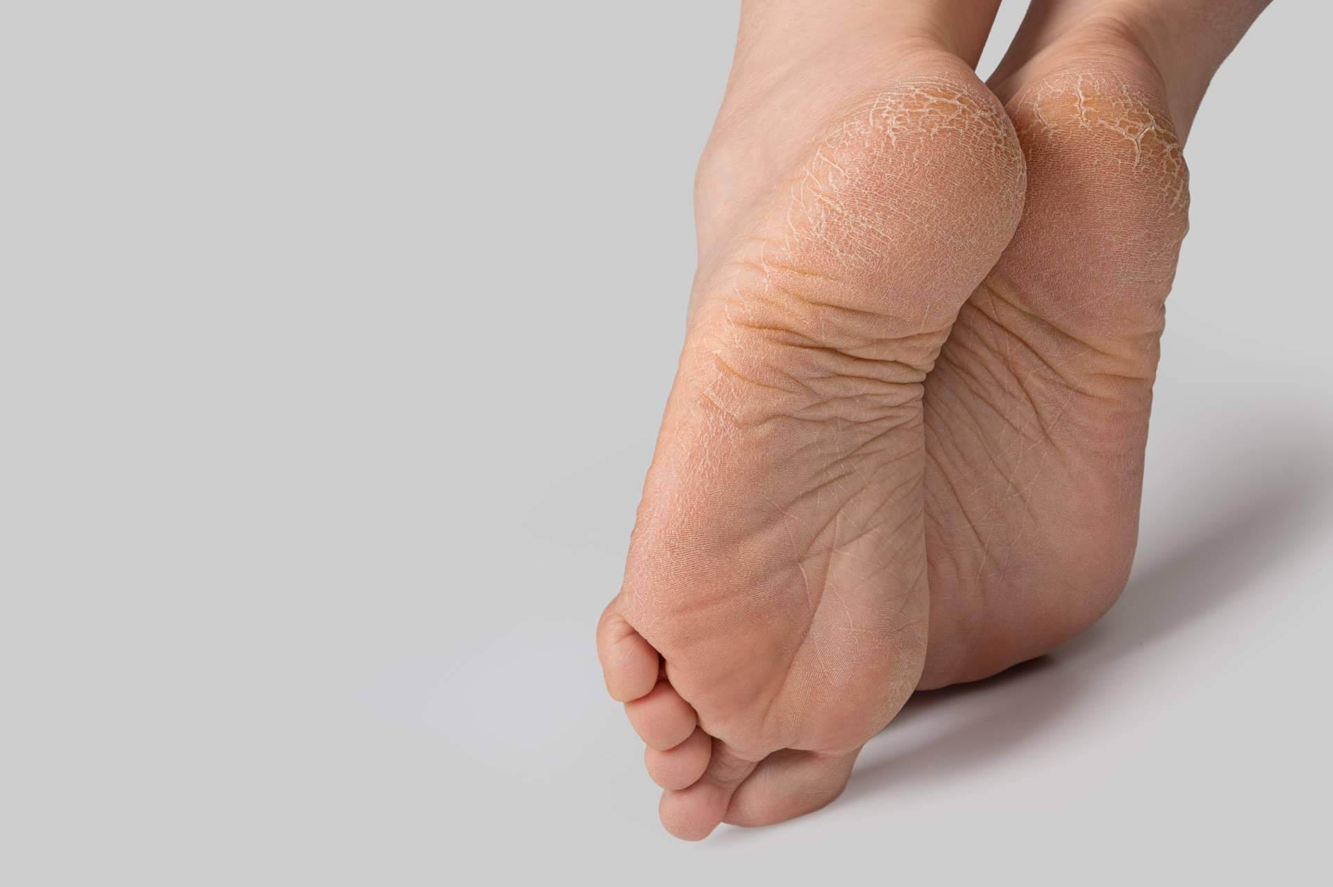 ¿Por qué es importante utilizar plantillas a medida para las diversas dolencias en el pie? Clínica de Podología Integral Pododerm