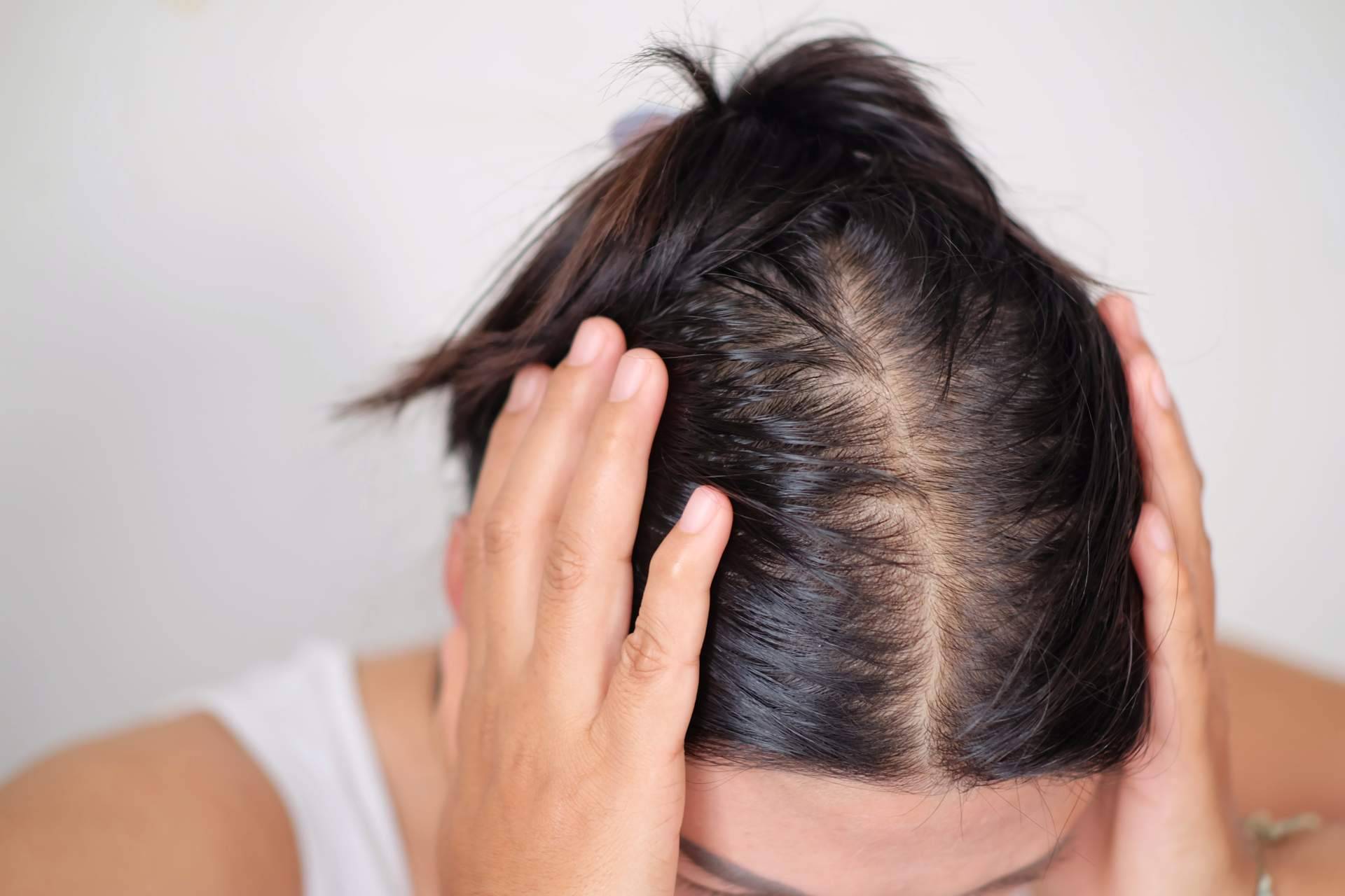 Élite Capilar explica qué es el efluvio telógeno y cuáles son sus causas