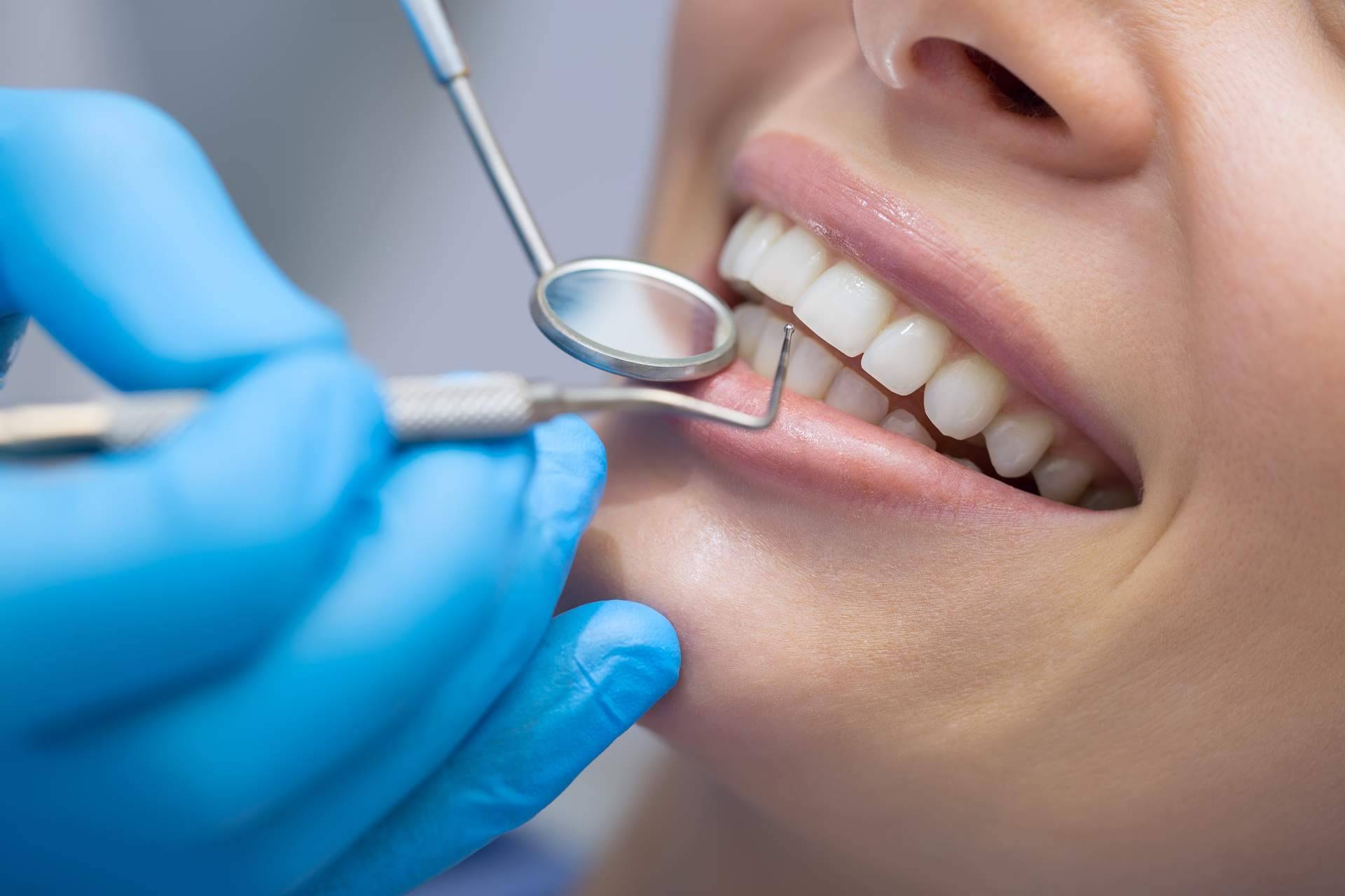 ¿Qué problemas estéticos se pueden solucionar con las carillas dentales?
