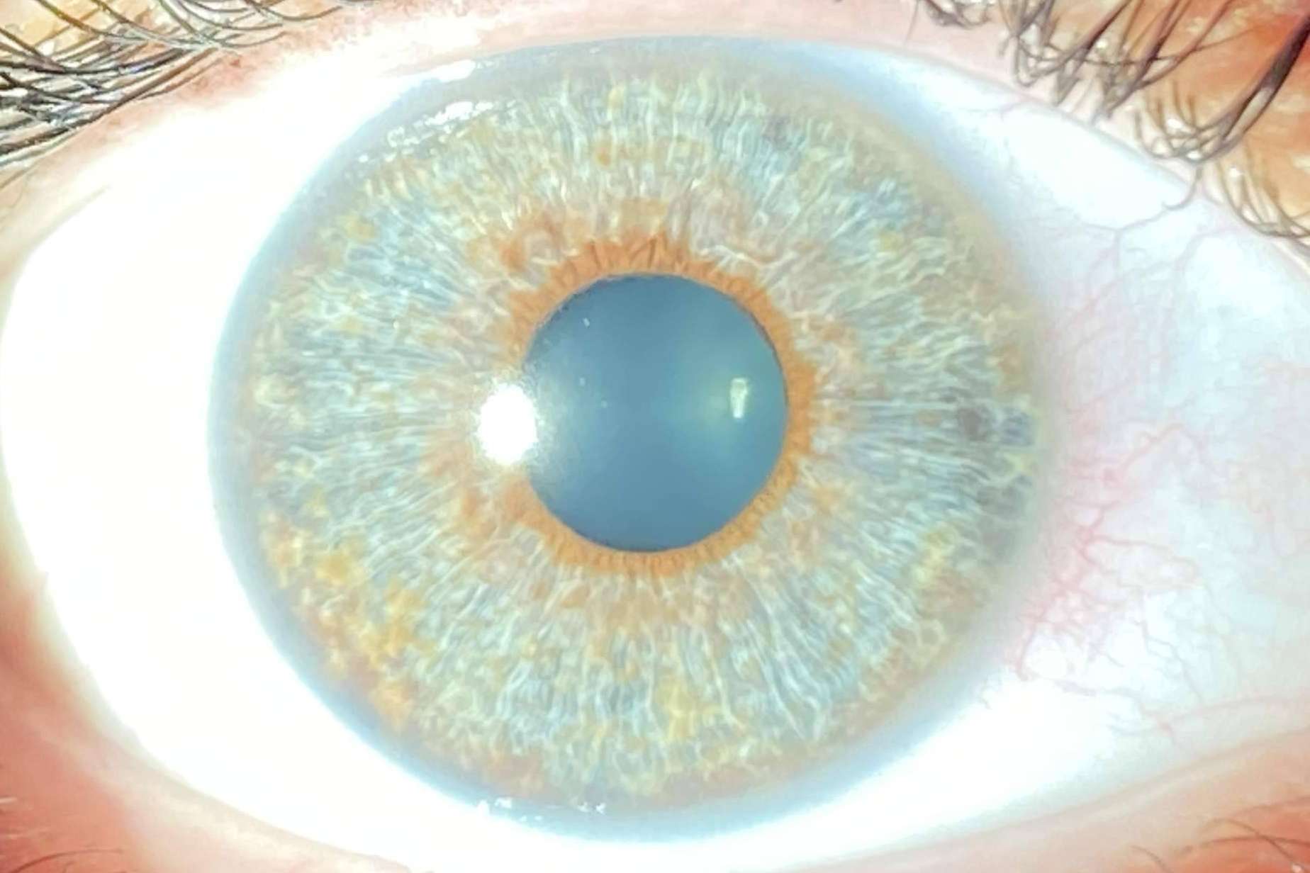 Los avances en las operaciones de cambio de color de ojos con láser, con Clínica Eyecos