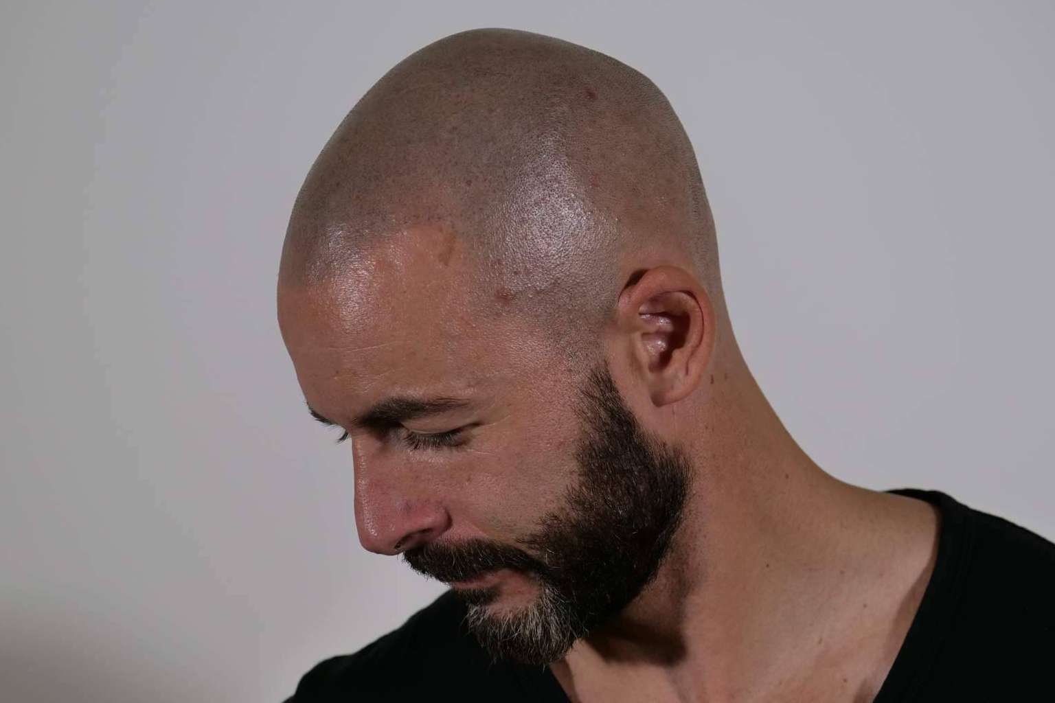 Aldemar Campos, calidad y experiencia para los clientes en la micropigmentación capilar