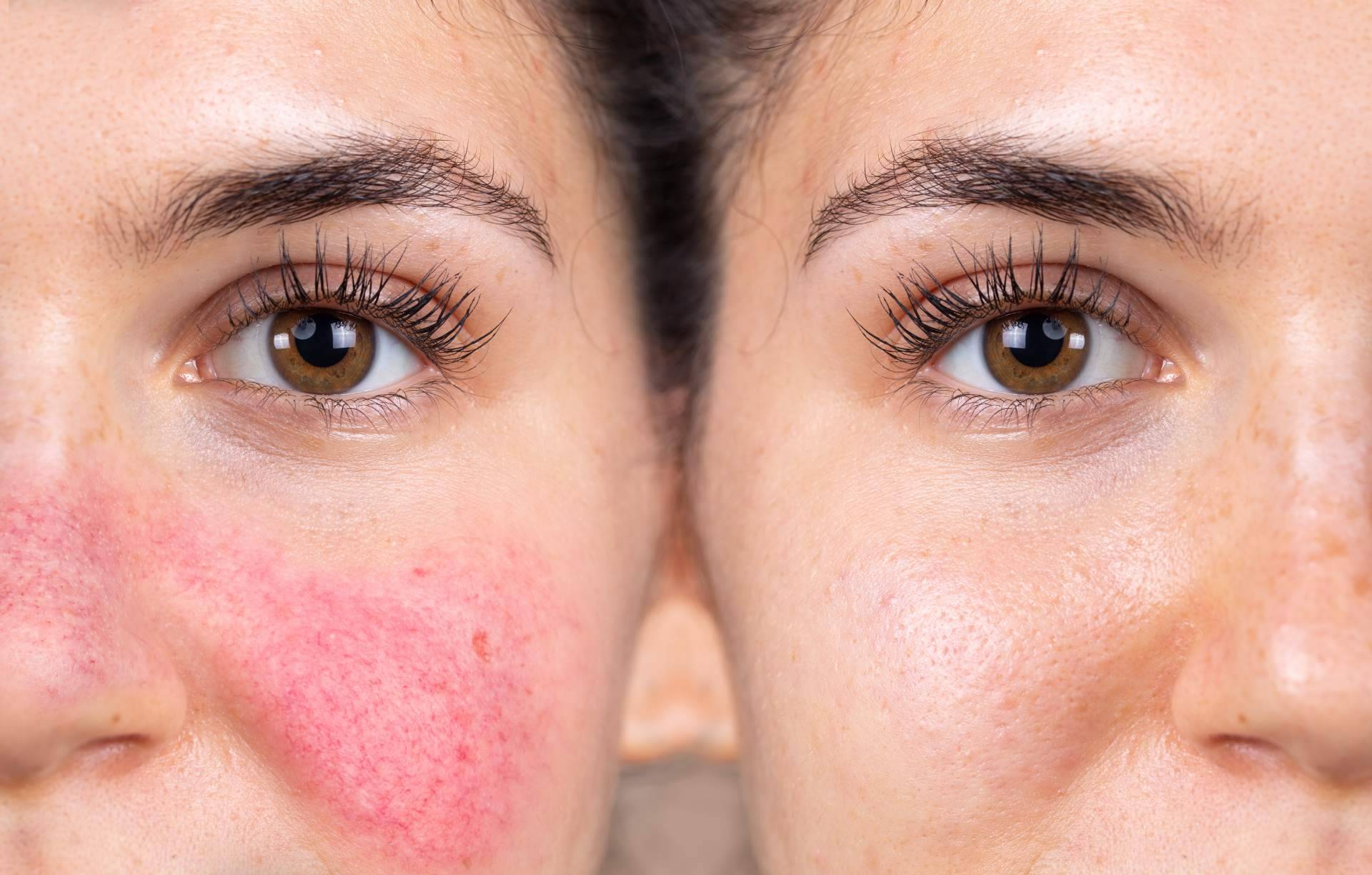 ¿Cómo hay que cuidar correctamente la rosácea? Los expertos de La Para-Farmacia del Puerto