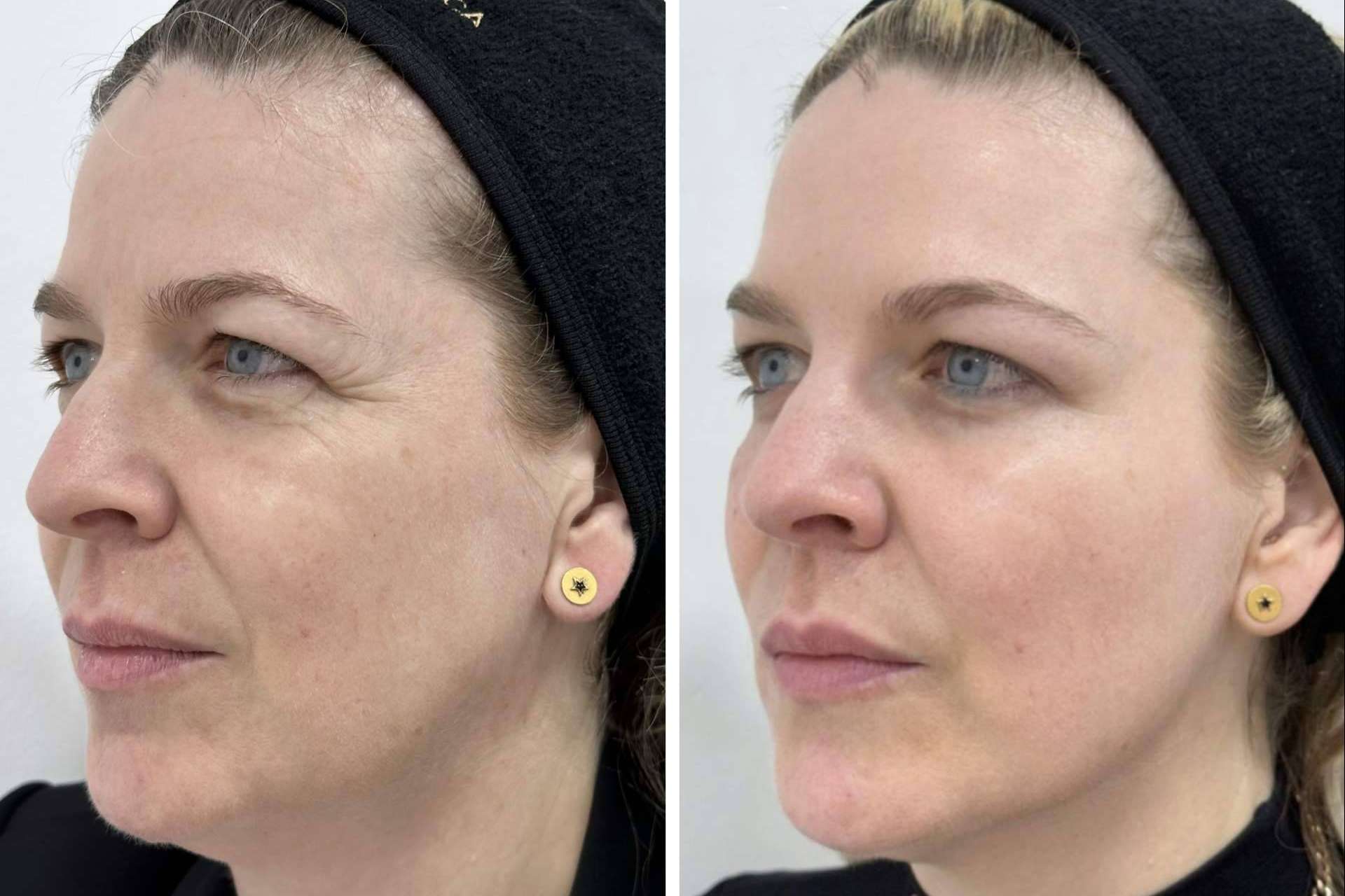 Los tratamientos faciales de Clínica VISO permiten a las personas mejorar su apariencia
