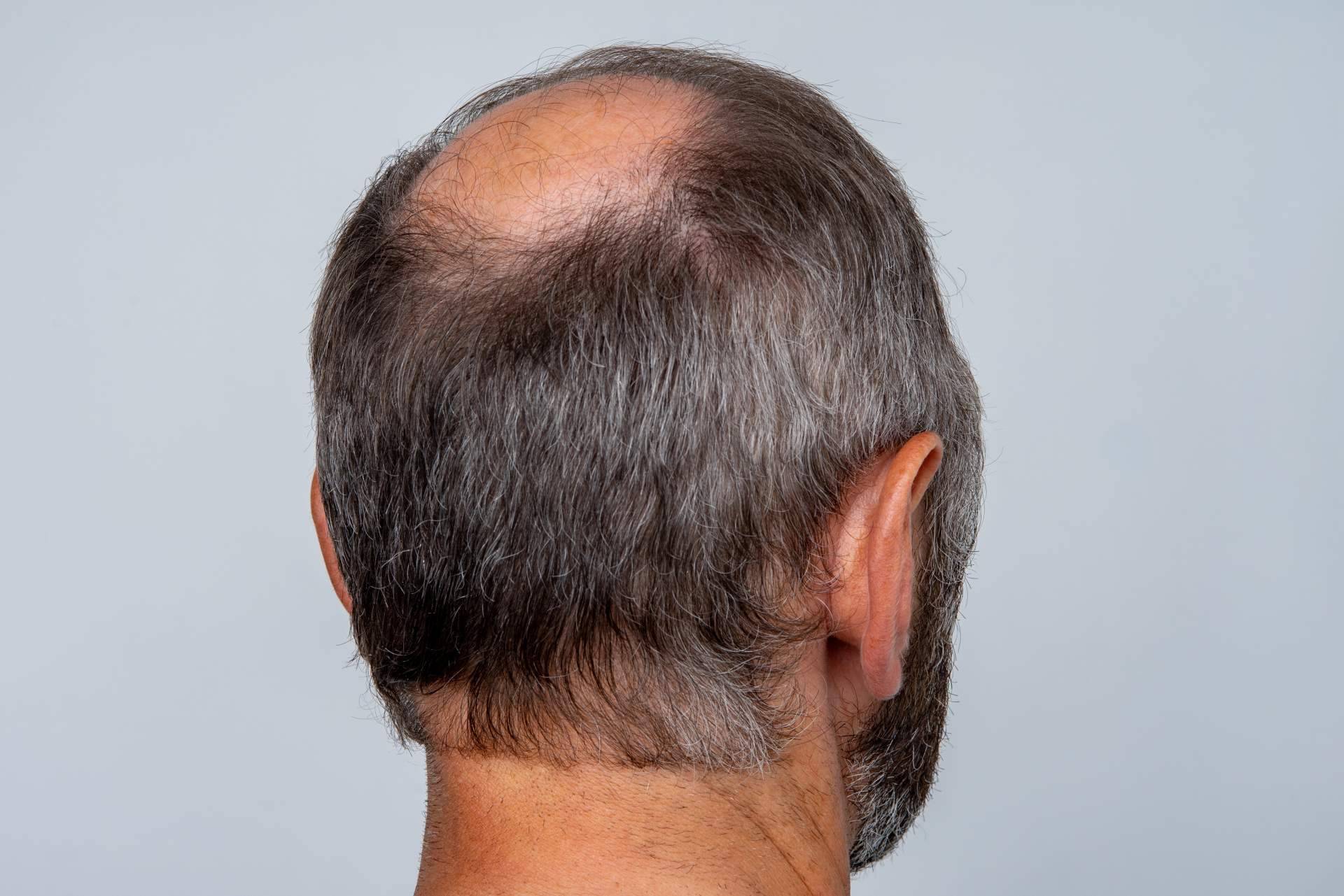Microinjerto capilar para hombres en verano, con Capilar Innovation Clinic