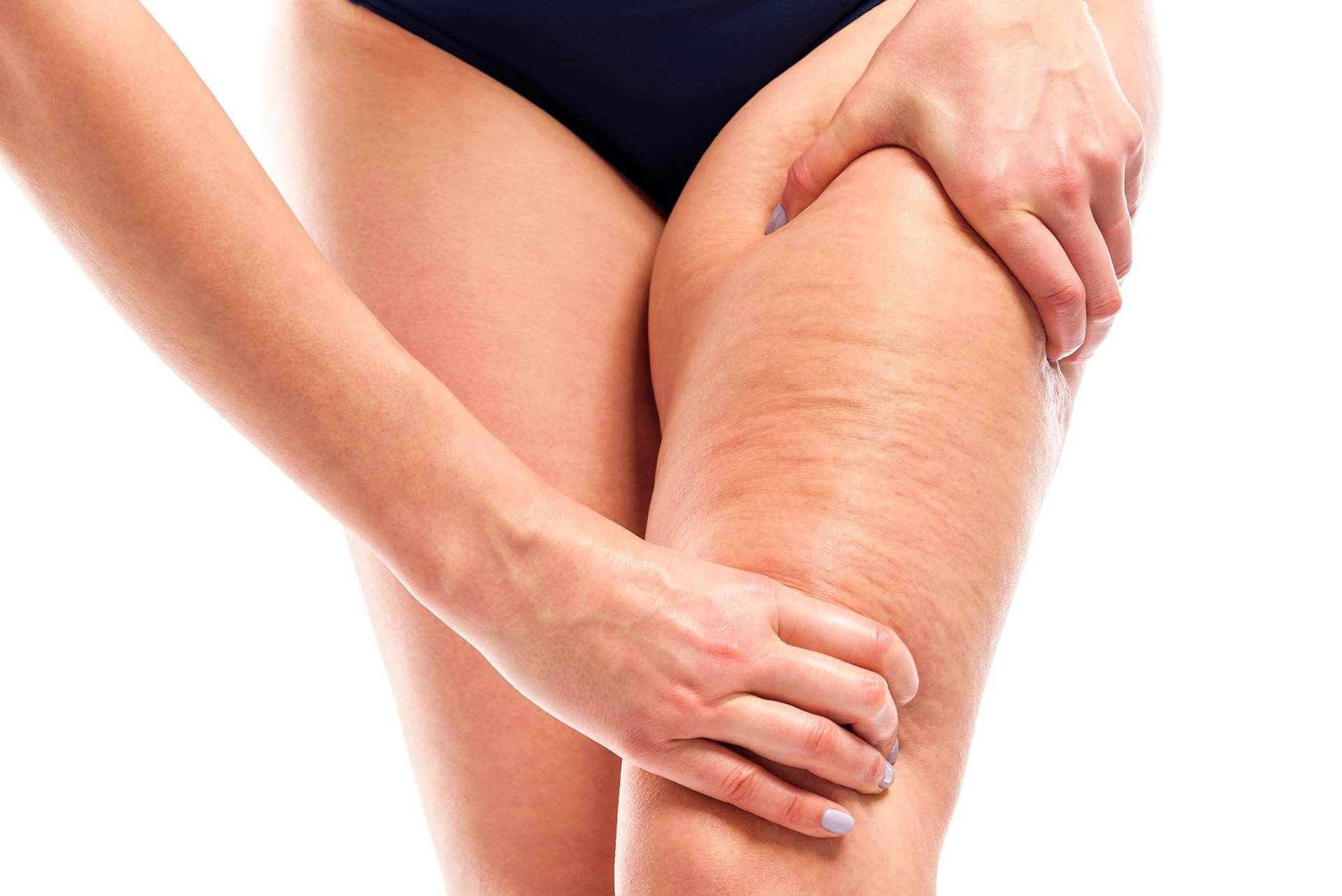 Vacuslim 48, tratamiento corporal para tratar y reducir la celulitis ¿Realmente funciona?
