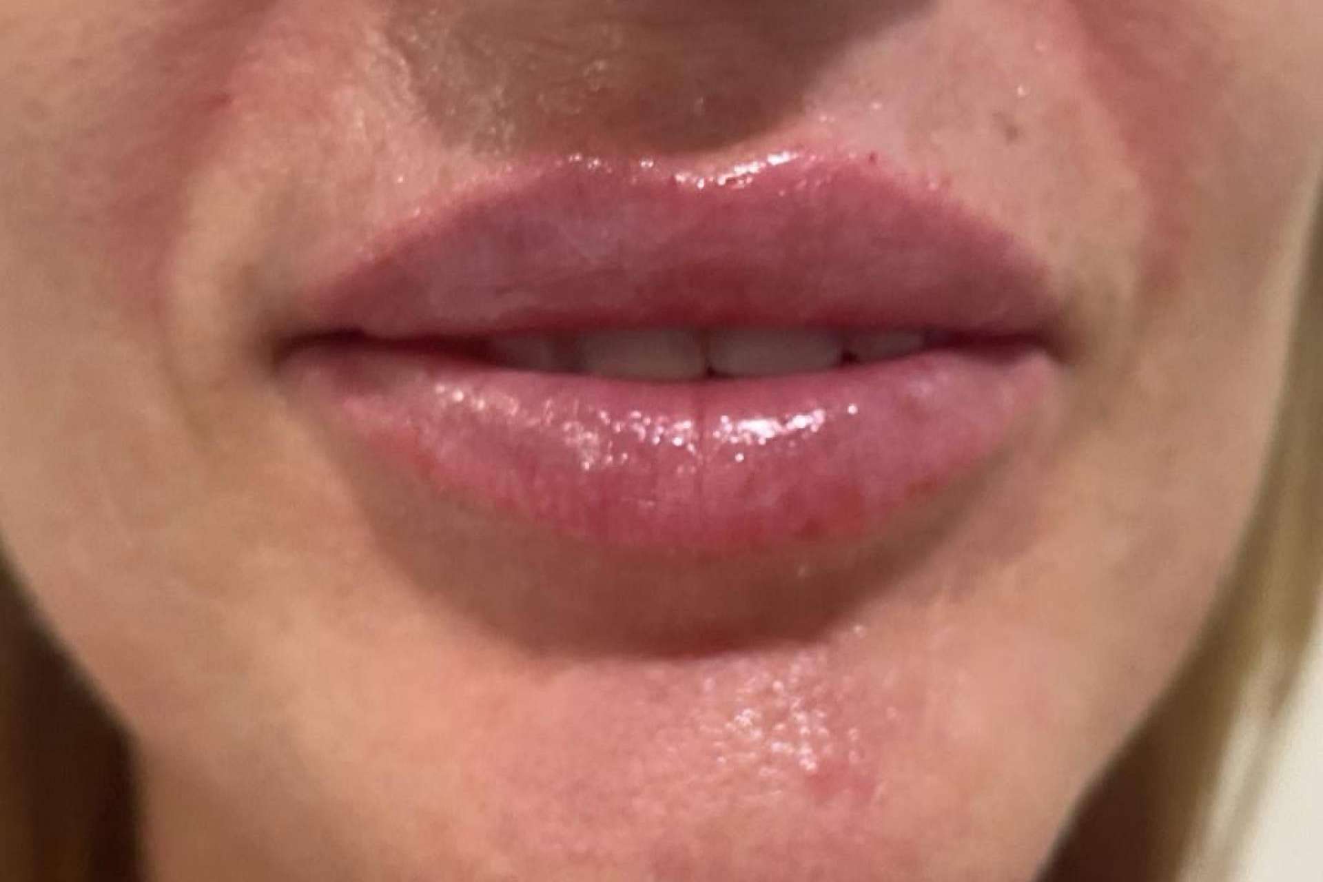 Aumento y remodelación de labios con ácido hialurónico