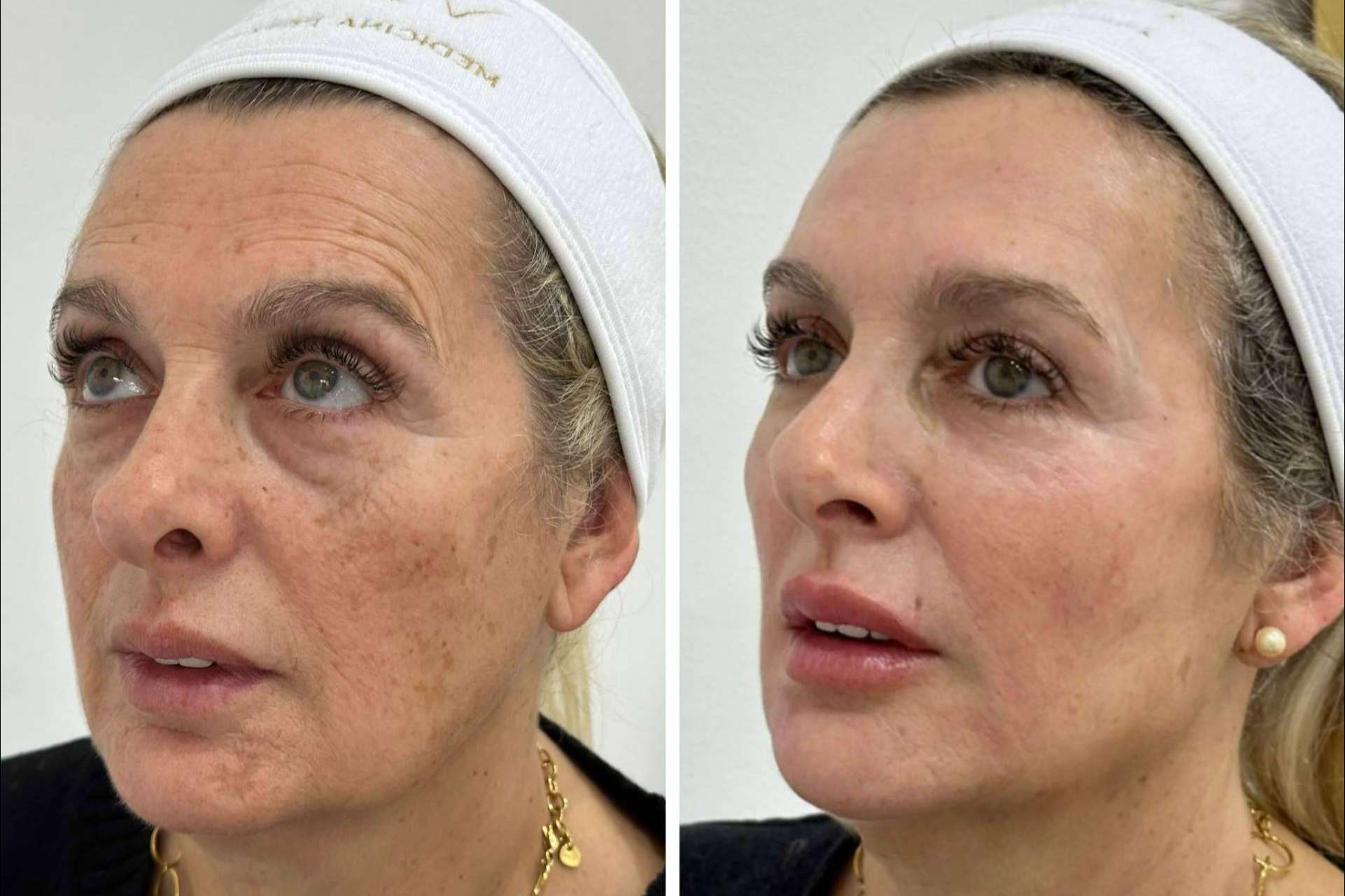 Combatir la flacidez facial, con Clínica VISO