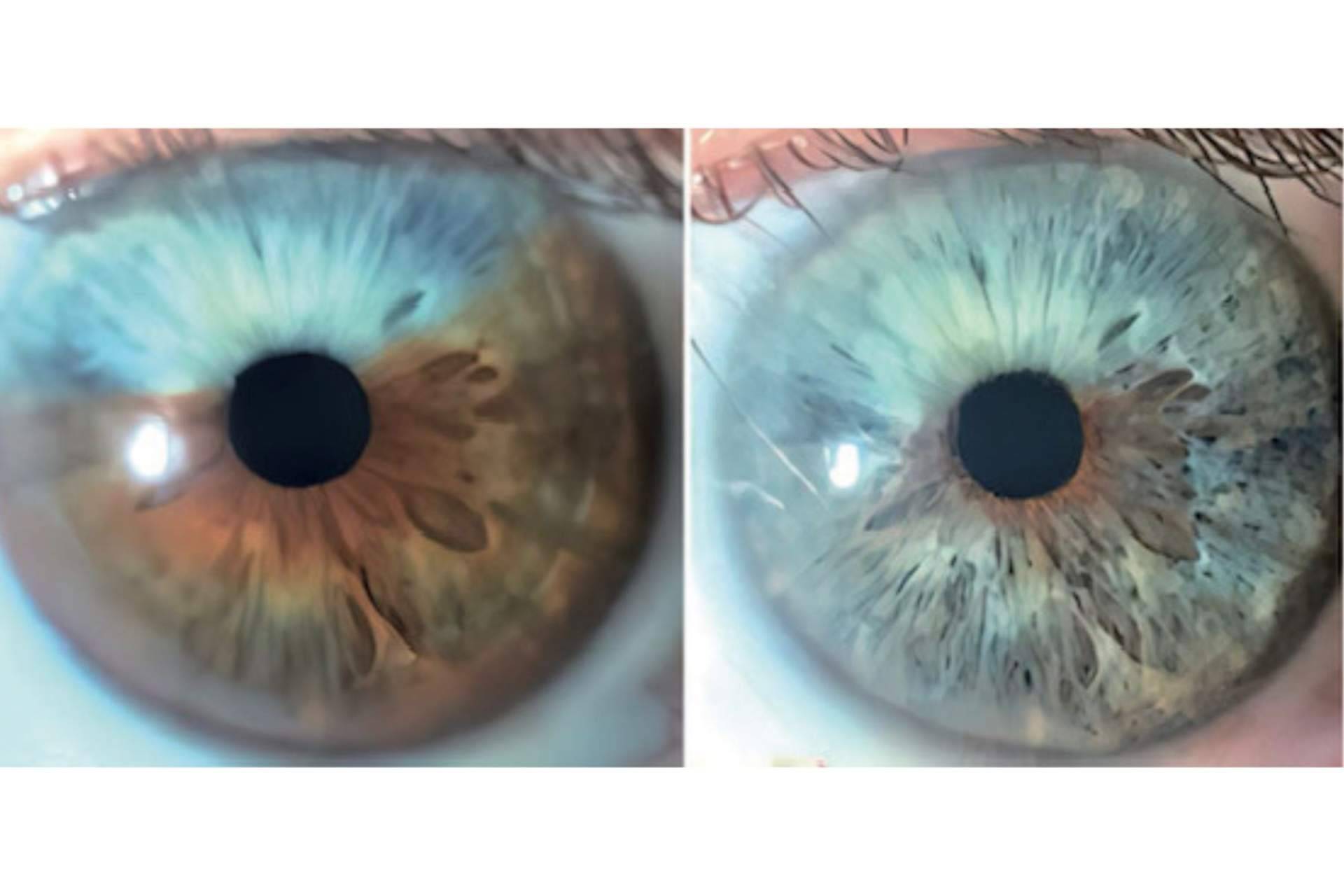 Los heterocromías y los nevus del iris pueden ser tratados con láser según Clínica Eyecos