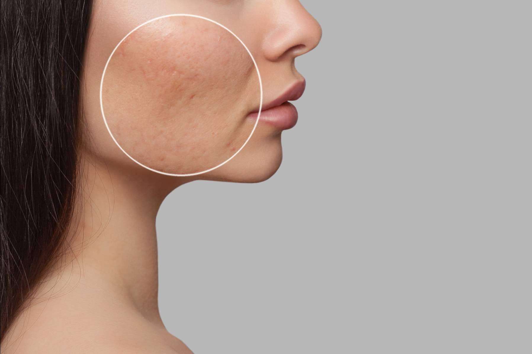 Tratamiento de cicatrices de acné con radiofrecuencia fraccionada con microagujas, en Alluring Clinic