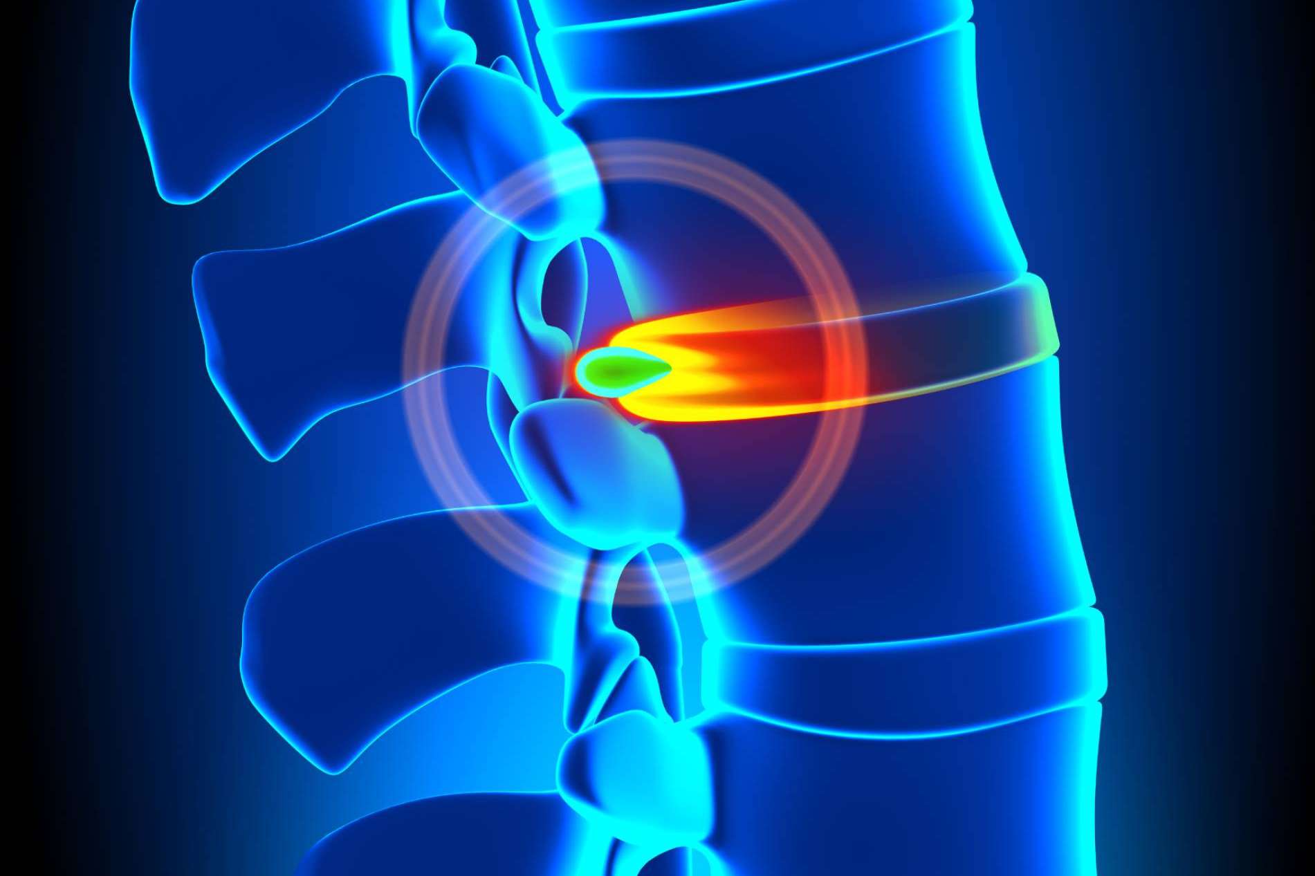 Hernia discal y andulación, un enfoque terapéutico innovador