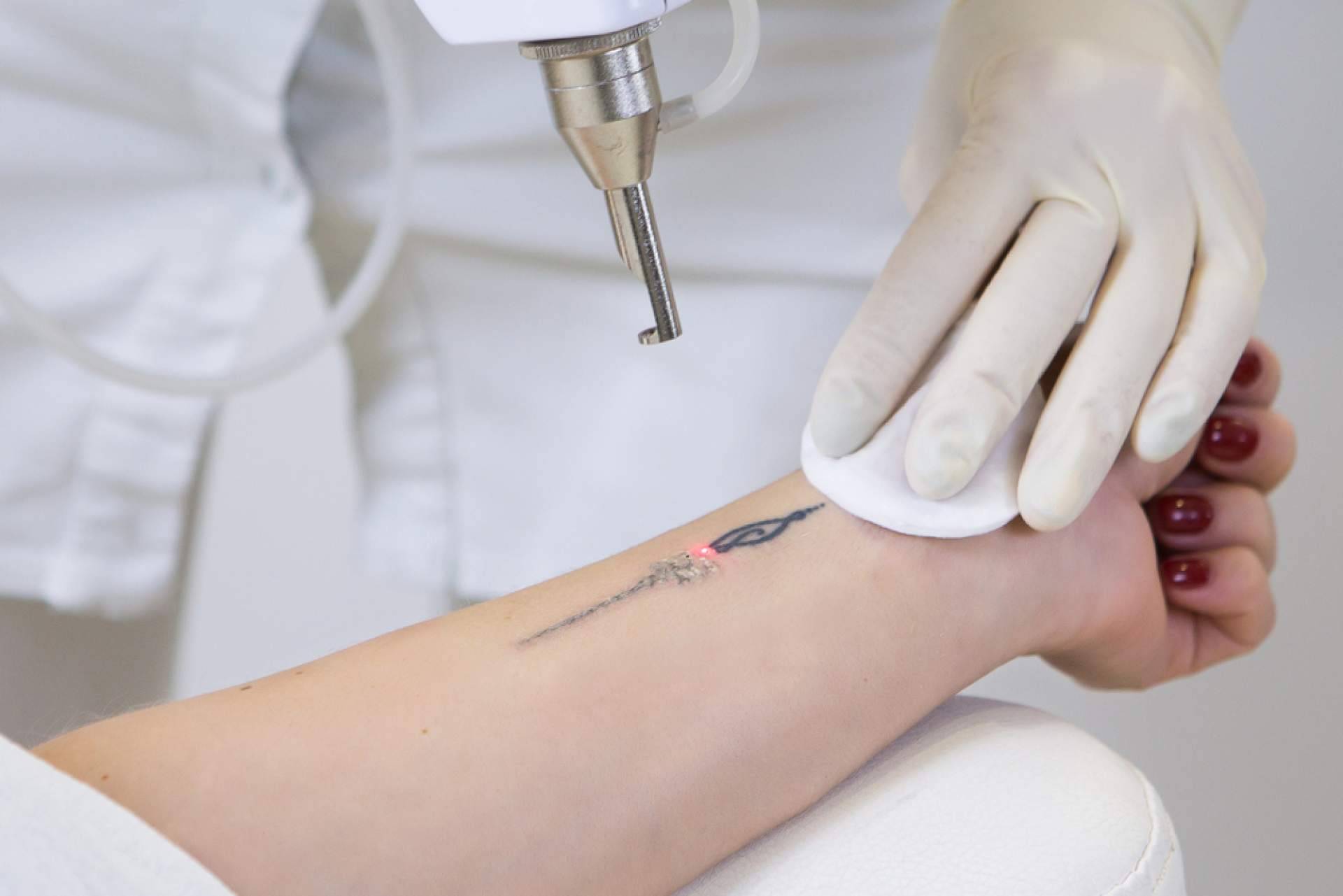 Centro Médico El Pilar, últimas tecnologías para la eliminación de tatuajes