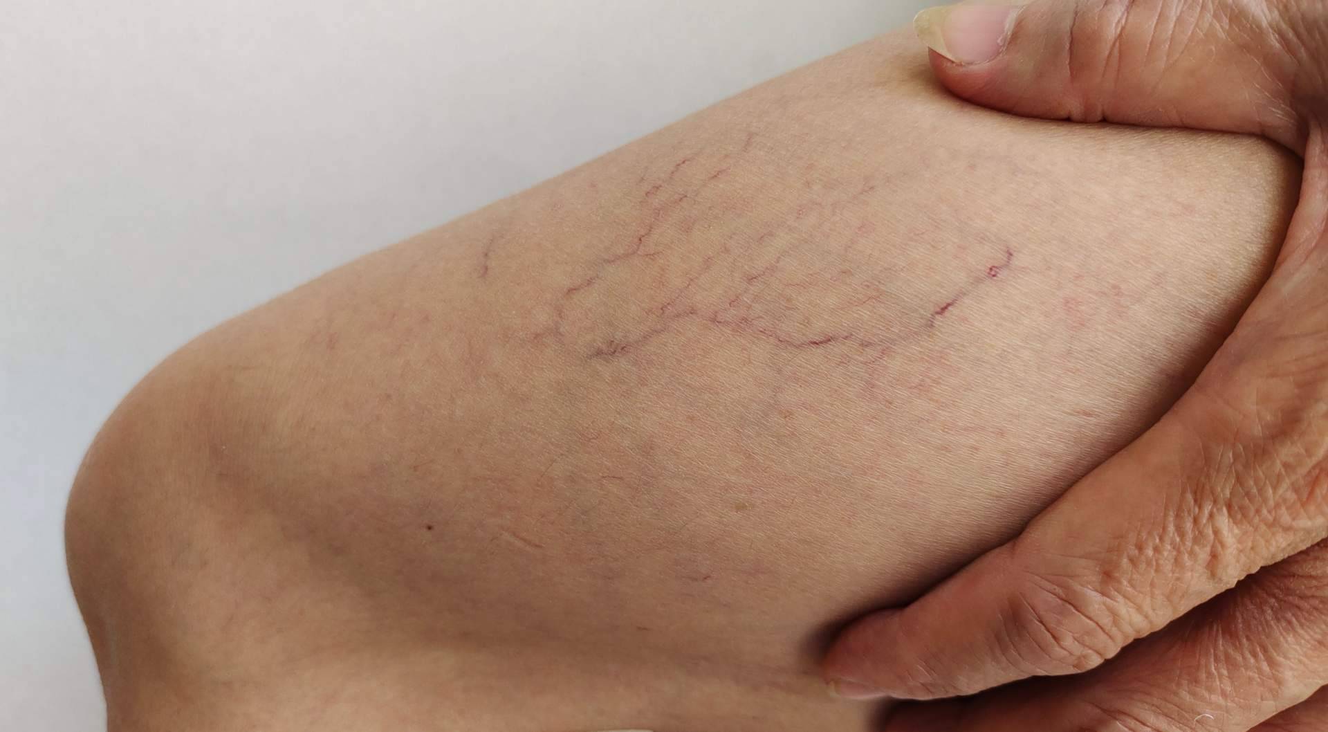 ¿Cómo resolver la pesadez de piernas e hinchazón en verano por mala circulación?
