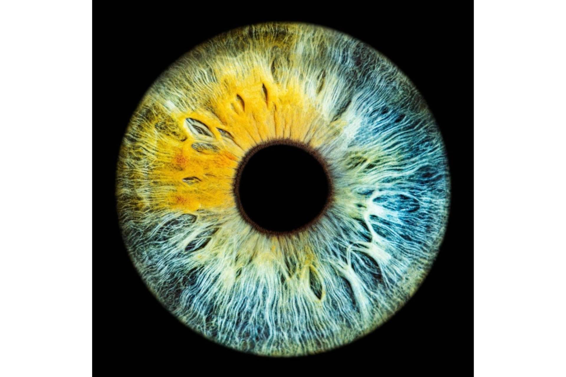 ¿Qué celebridades tienen una heterocromía ocular?, por Clínica Eyecos