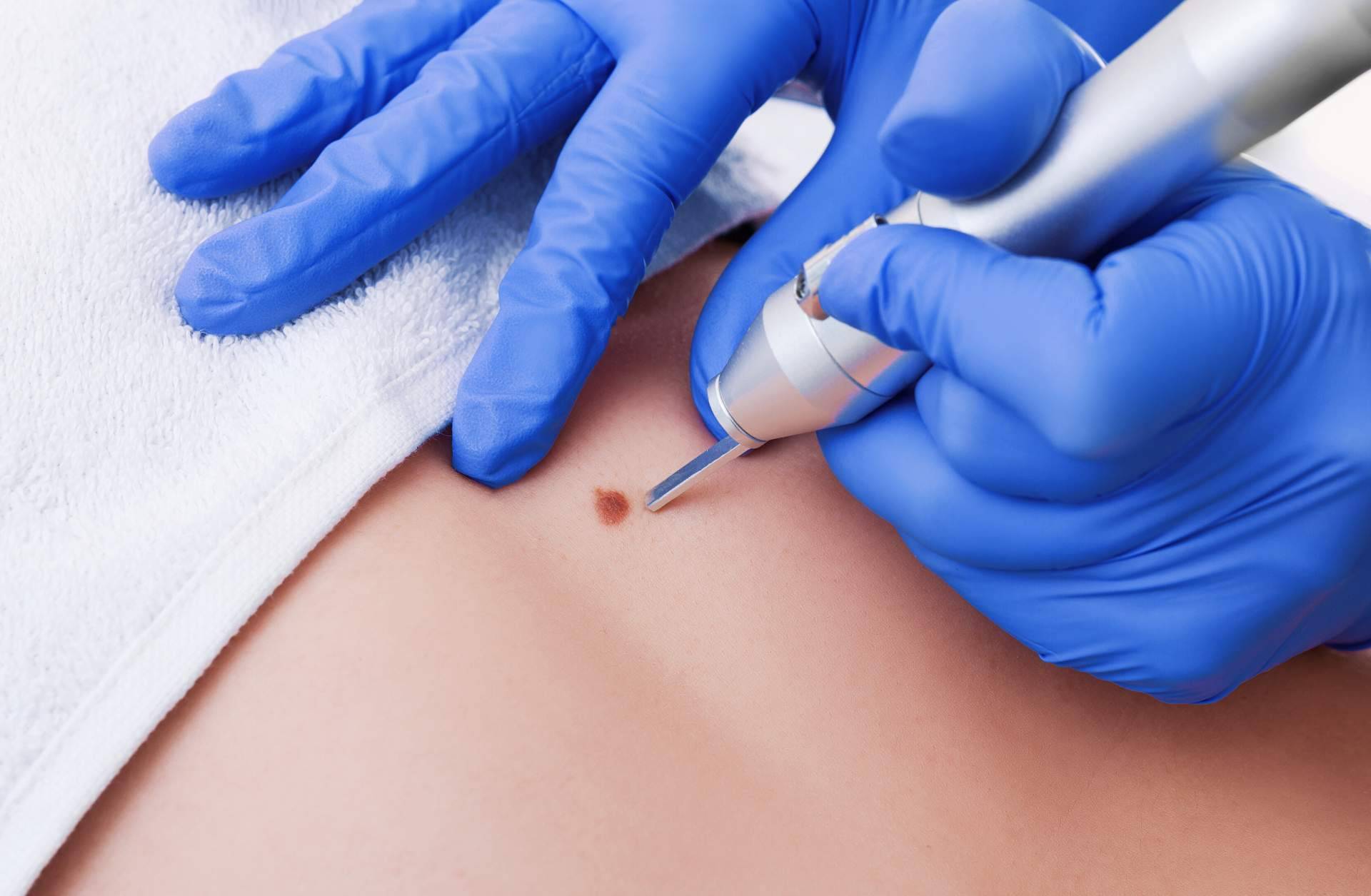Eliminar lunares y verrugas a través de los tratamientos más innovadores en Centro Estética El Pilar