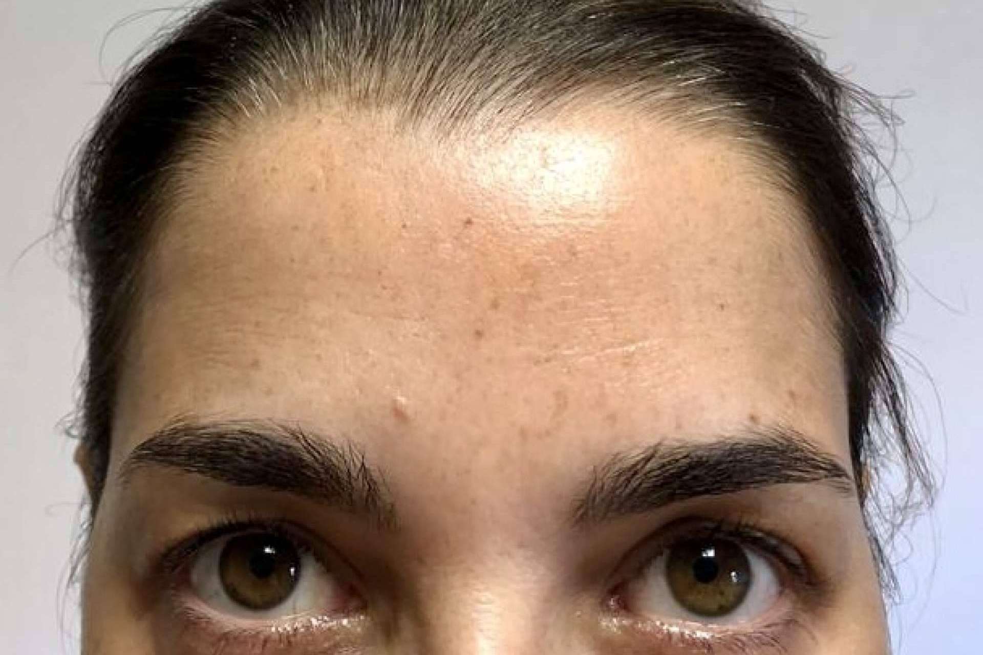 Lucir un aspecto natural y joven con el tratamiento de rejuvenecimiento facial de Clínica Amalfi