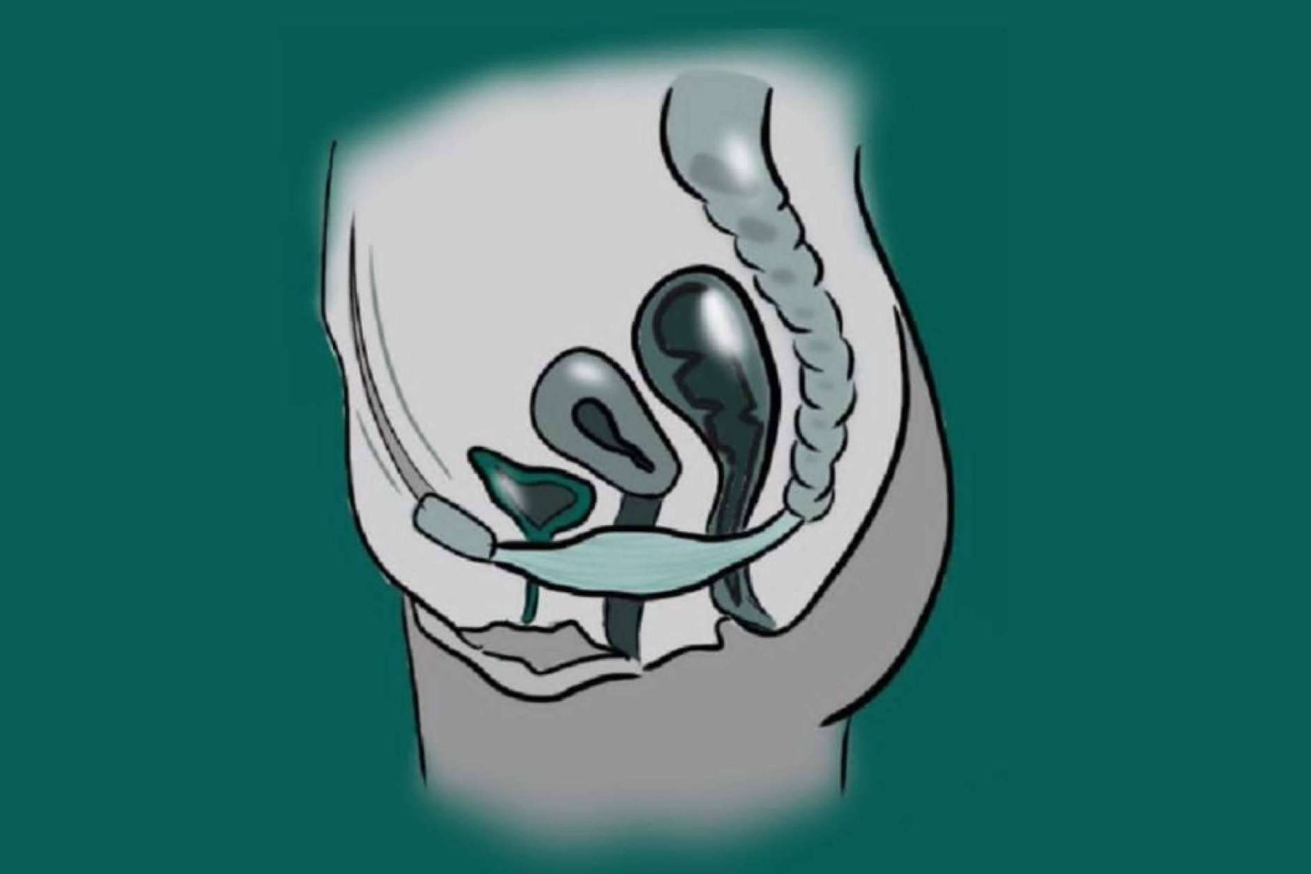 ¿En qué consiste un prolapso genital?, por el Dr. Nelson Díez