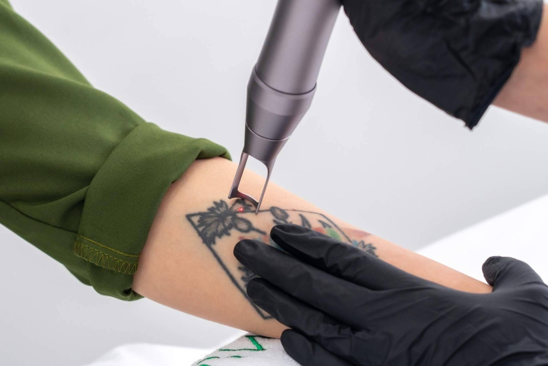 Tecnología avanzada para borrar tatuajes en Alicante, Ink Láser