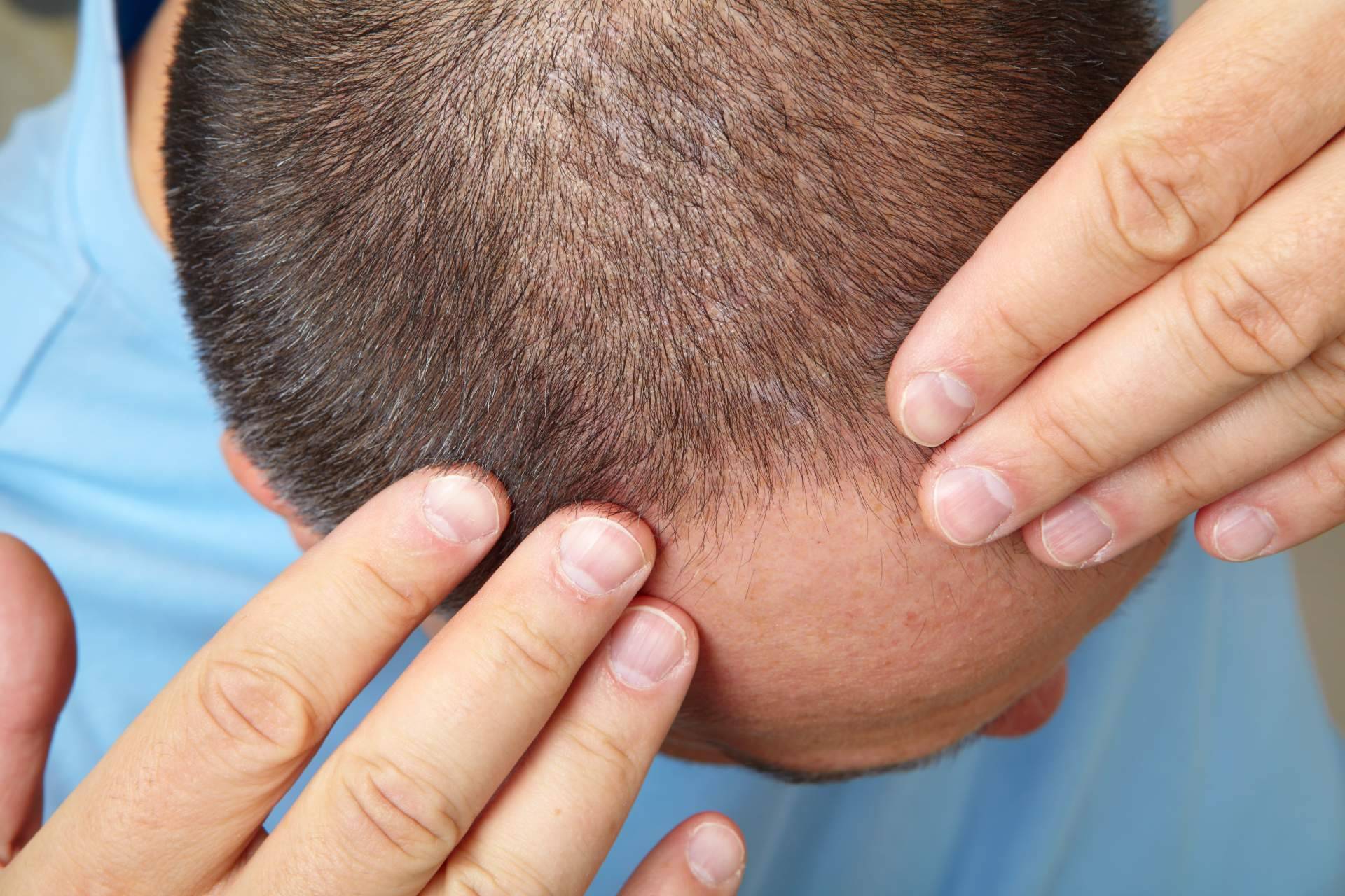 Cuánto tarda en crecer el pelo después de un injerto capilar, por MC360