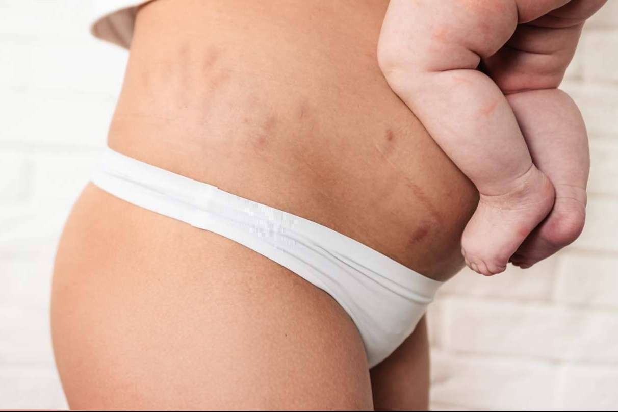 ¿Por qué es importante una buena recuperación posparto para el suelo pélvico?