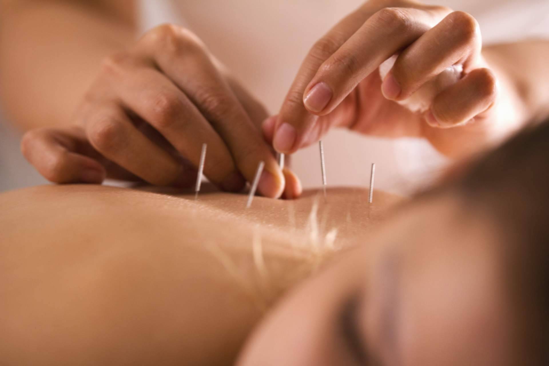 Los múltiples beneficios para la salud que aporta la acupuntura, por Shenti Wellness