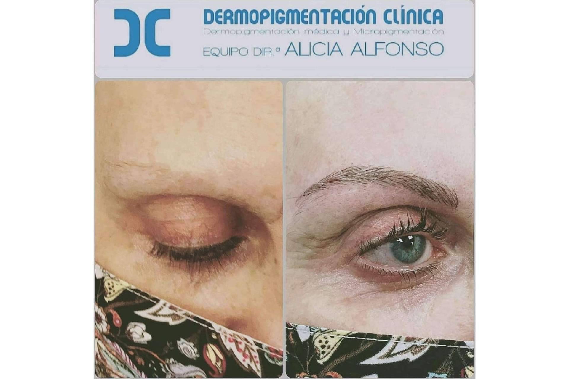 ¿Cuáles son las principales diferencias entre micropigmentación y microblading?