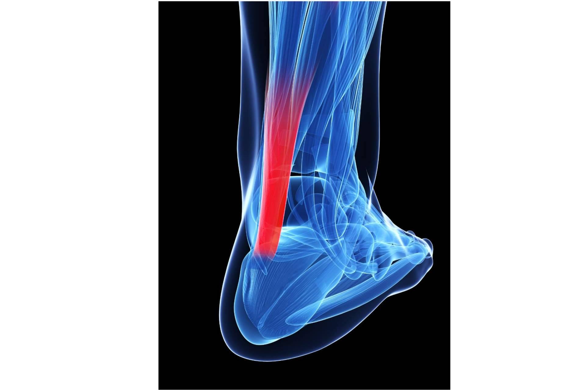 Ttendinitis con entrenamiento de fuerza, qué es y cómo mejorarla