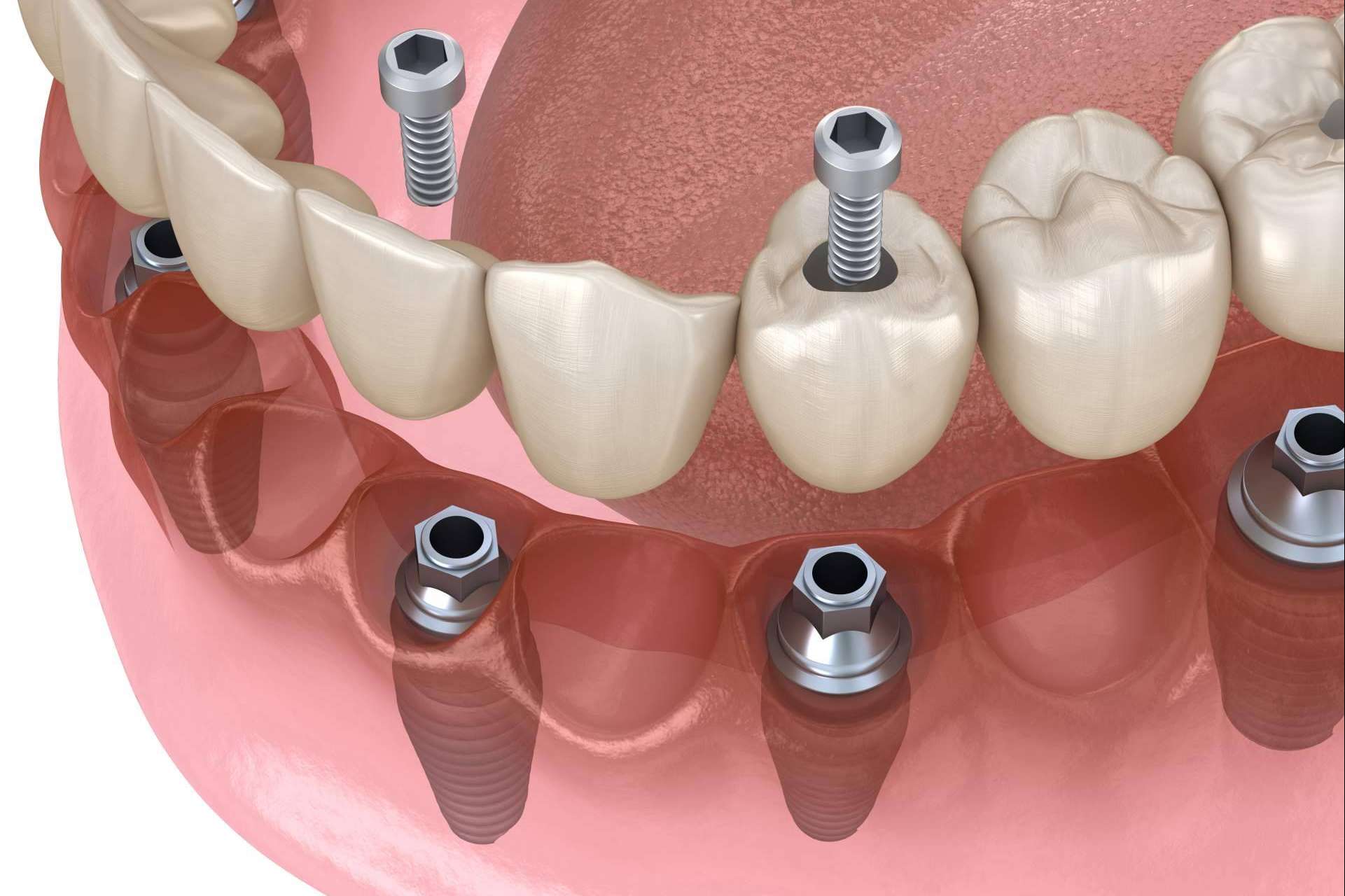 Recuperar la mejor versión de la sonrisa gracias a los implantes dentales inmediatos de DeltaDent