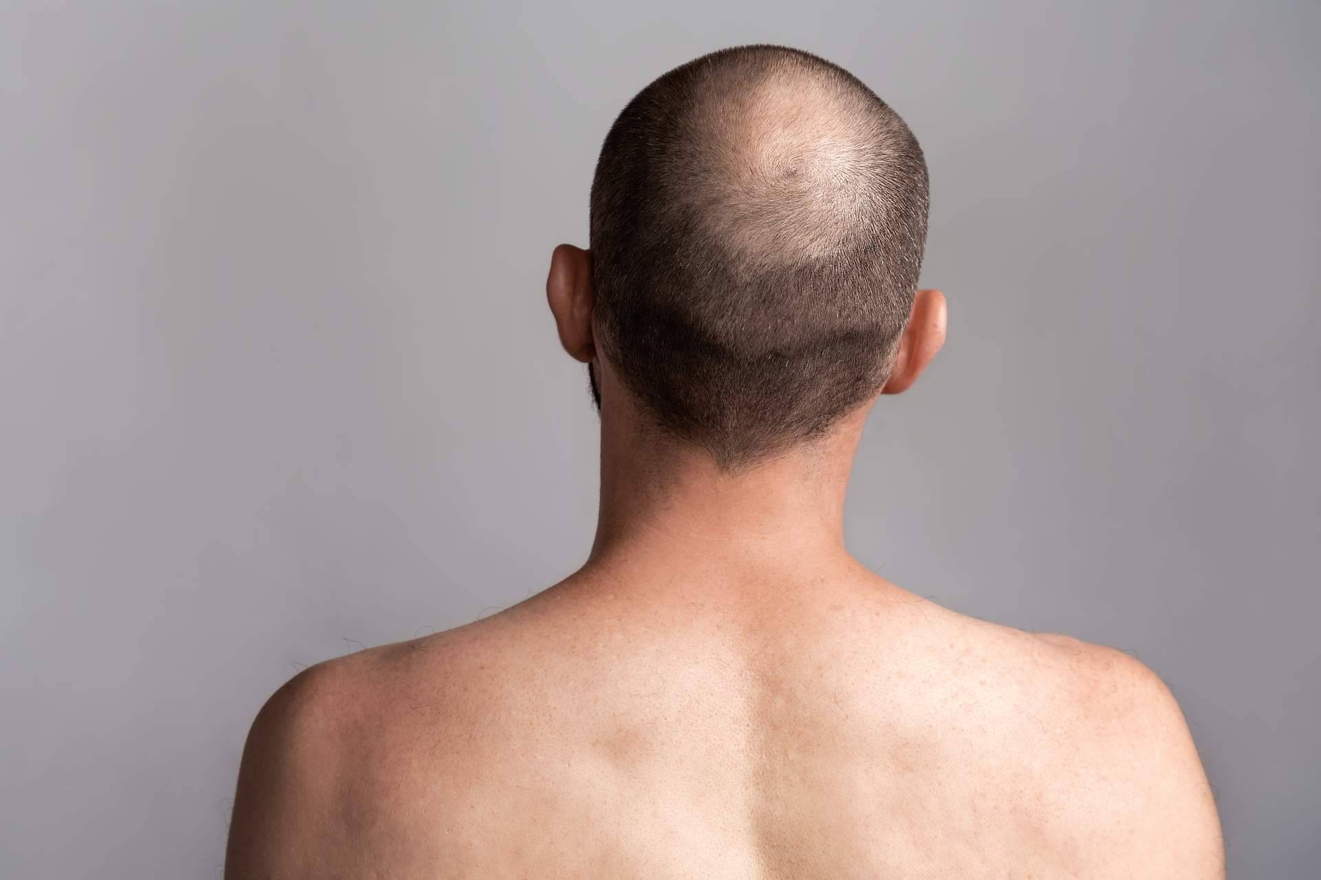 Tratamientos para la alopecia androgénica con Saw Palmetto