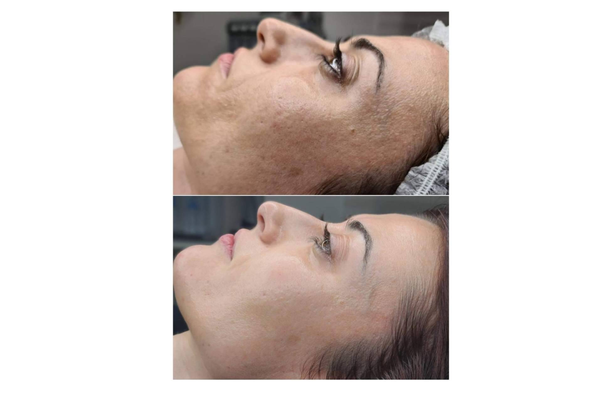 Renovación celular con biomicroneedling en Clinica Marta Solà, una técnica basada en espículas de esponja