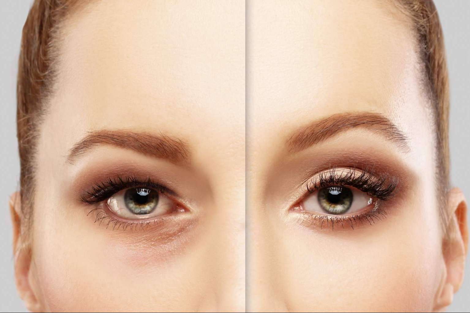 Combatir las ojeras con ácido hialurónico; el tratamiento no invasivo de Centro Estética El Pilar
