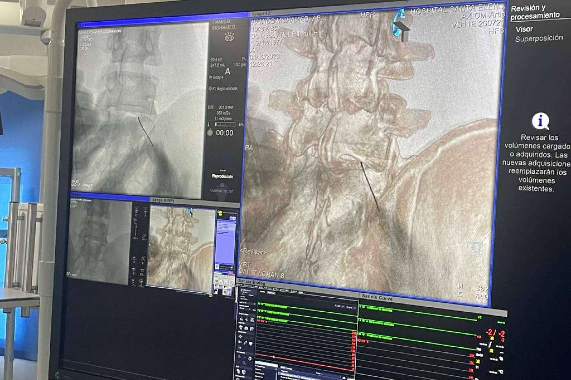 Al 82% los pacientes con hernia discal les funciona el tratamiento láser, en una sola sesión