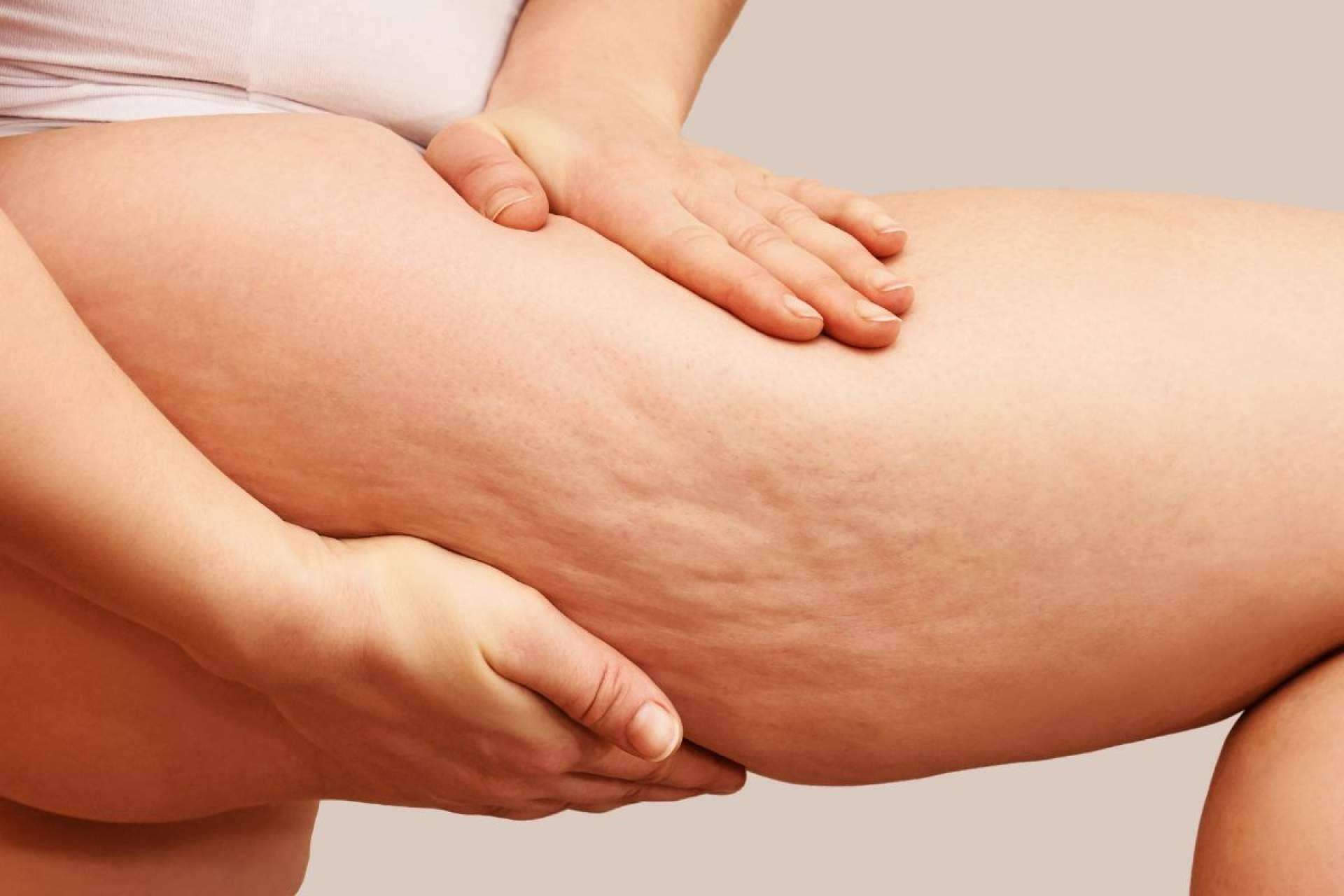 Las principales causas y soluciones de la celulitis