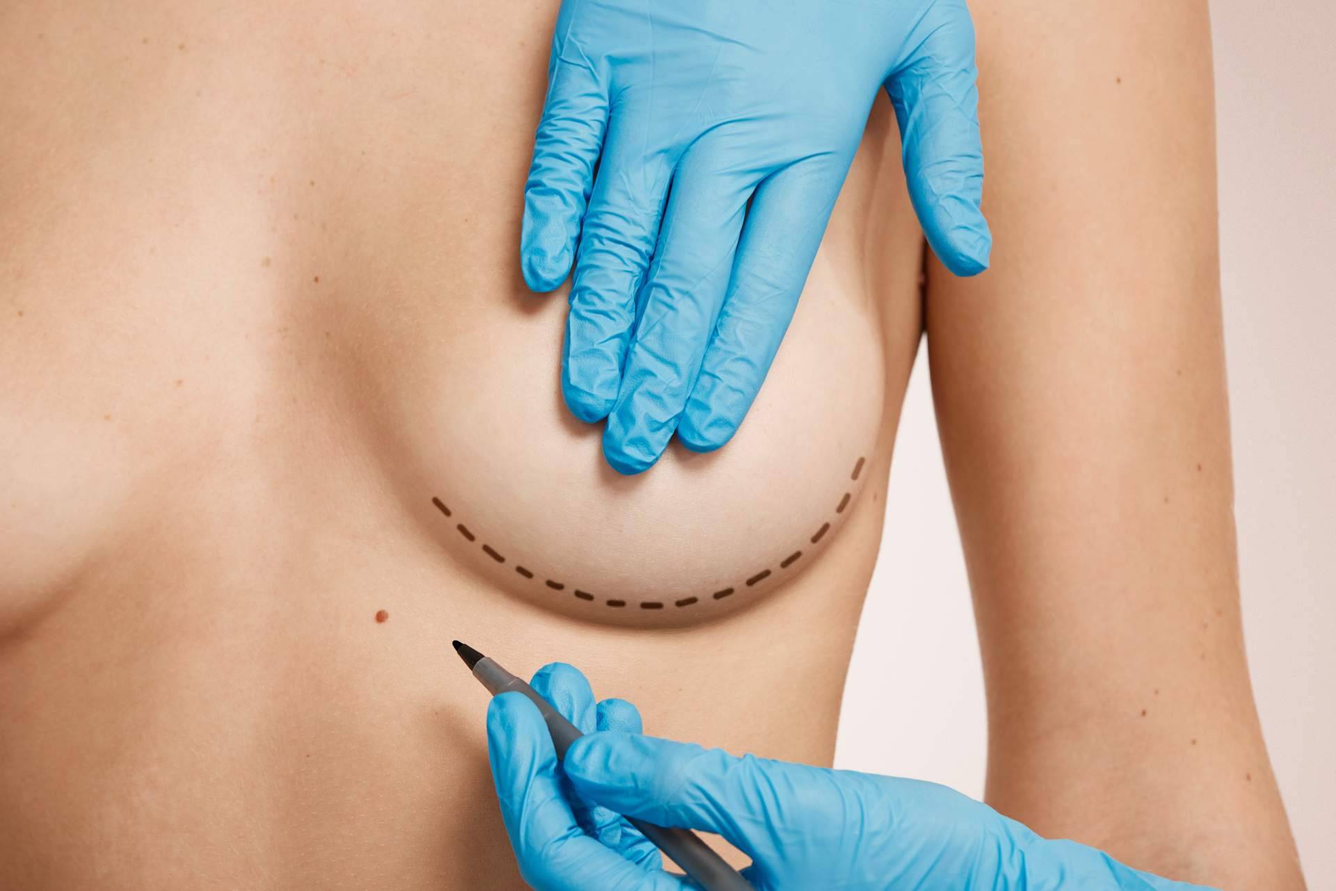 Beauty&Beauty, un centro especializado en procedimientos de recambio de implantes mamarios
