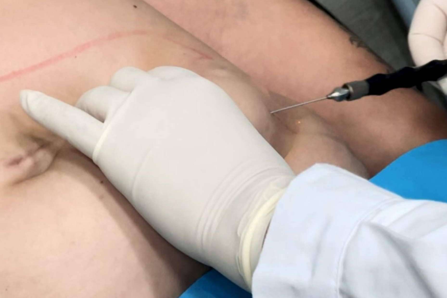 360Clinics Líderes en el tratamiento Lipo Láserfit Medical, revolución en tratamientos corporales sin cirugía