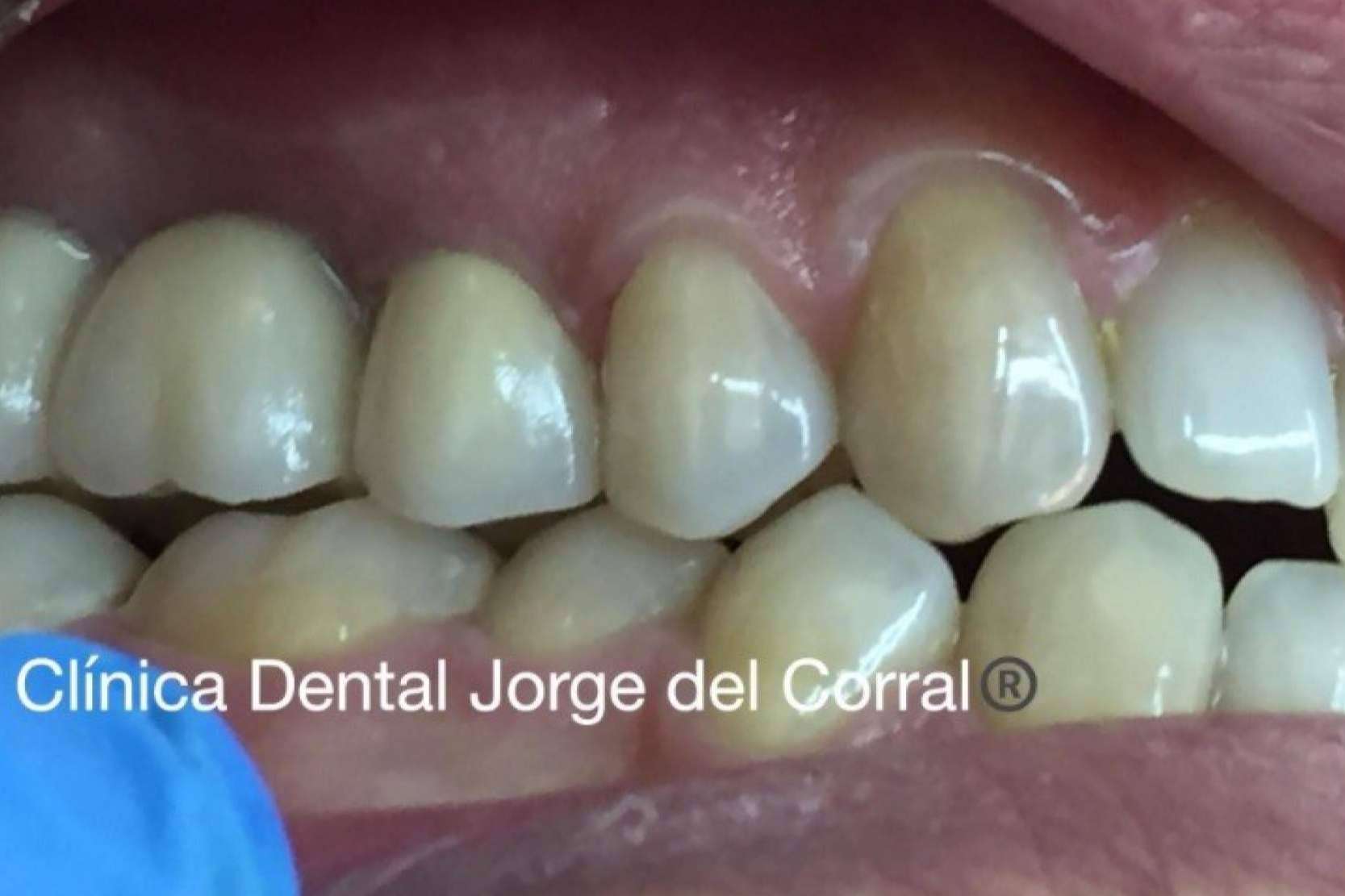 La Clínica Dental Jorge del Corral, en Hortaleza, innova con prótesis fijas de zirconio diseñadas por ordenador