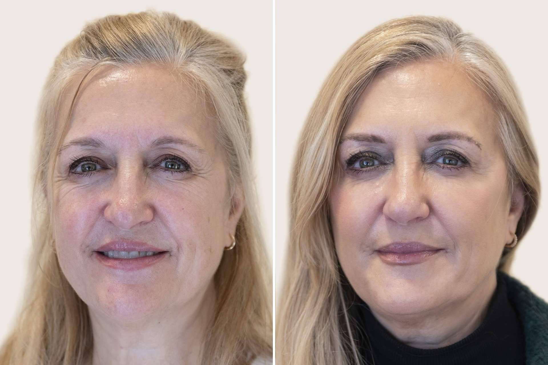 Armonización facial, el secreto de belleza que triunfa entre las 'celebs' mayores de 40