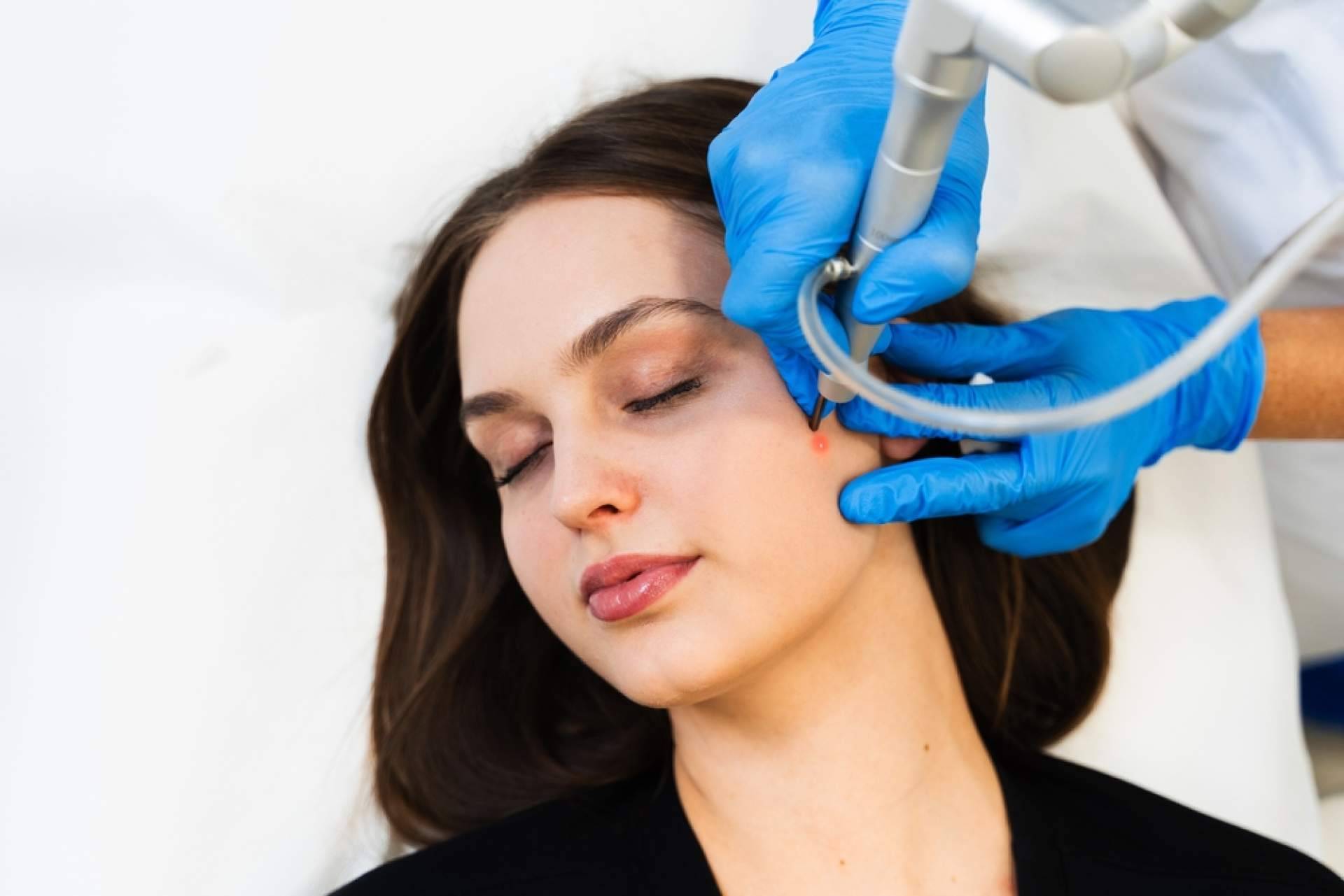 Eliminar lunares y verrugas de forma personalizada y sin marcas, la propuesta del Centro Estética El Pilar