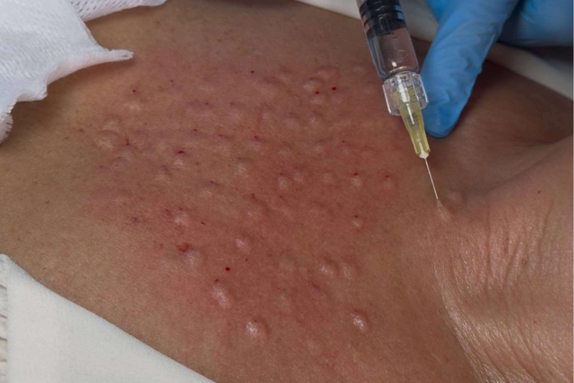 El tratamiento médico con esperma de salmón que está dando la vuelta al mundo; los polinucleótidos