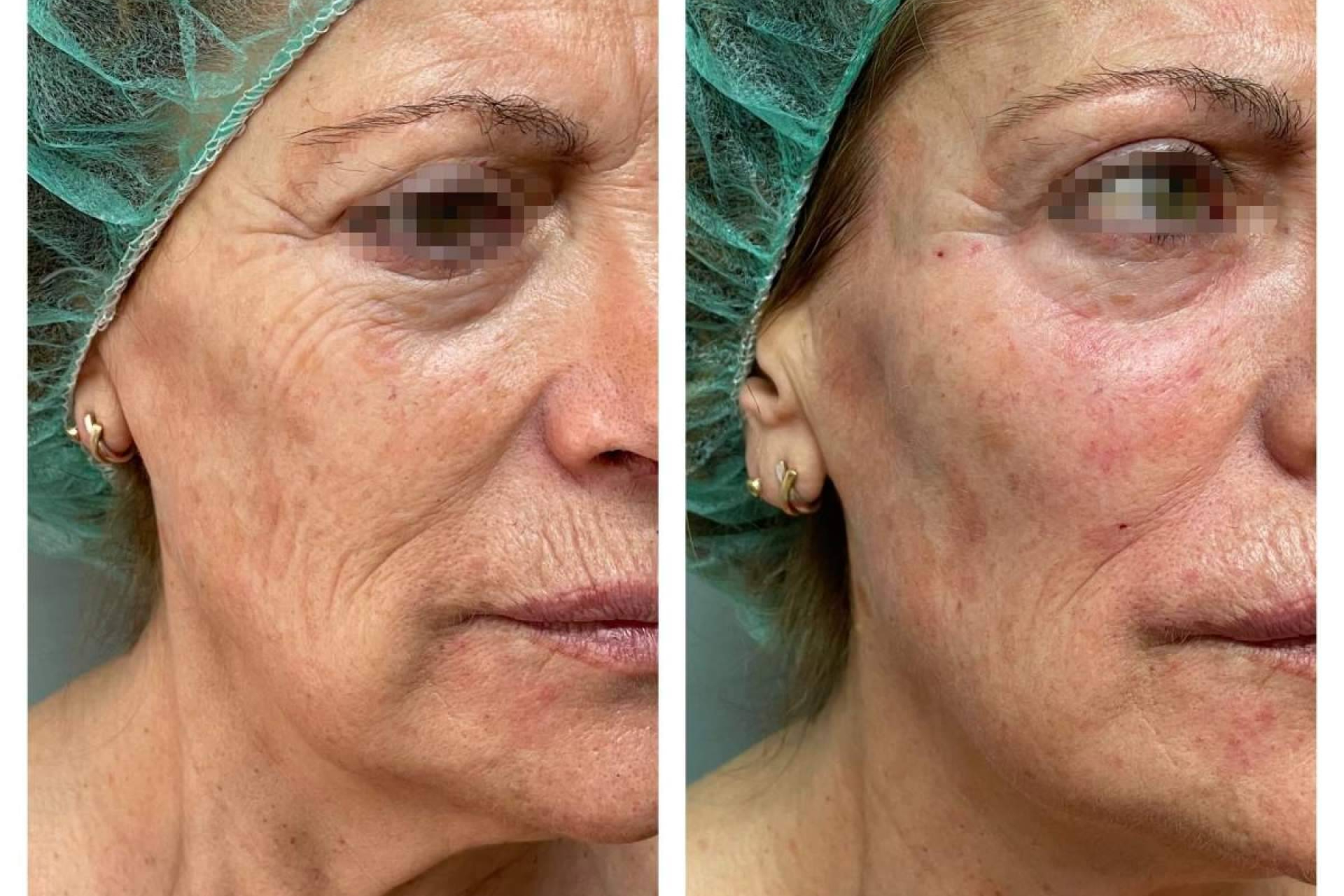 ¿Por qué el lipofilling facial gana popularidad en 2026 como alternativa al ácido hialurónico?