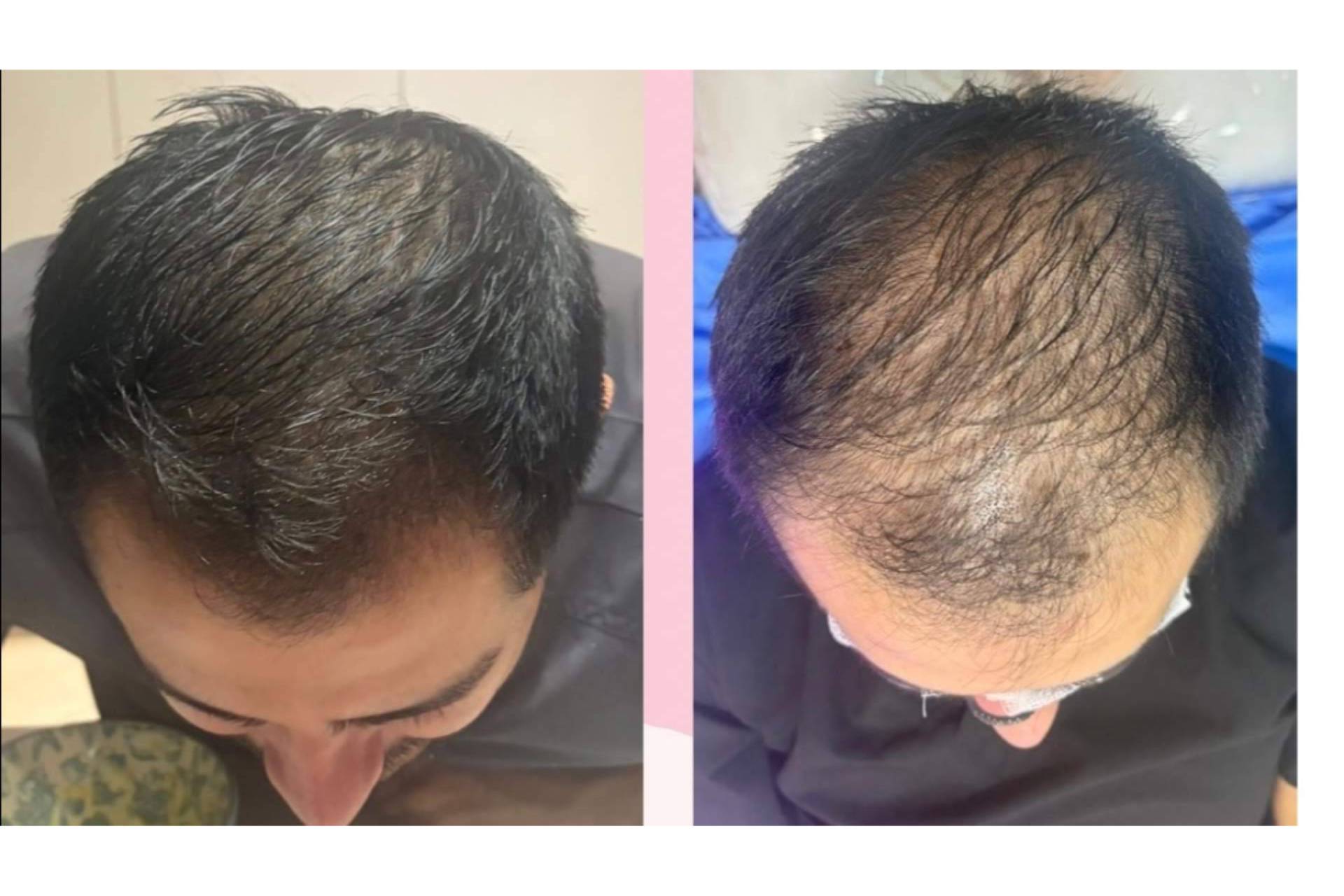 Dra. Janeth Arévalo analiza las nuevas tendencias en el tratamiento de la alopecia androgenética para 2027