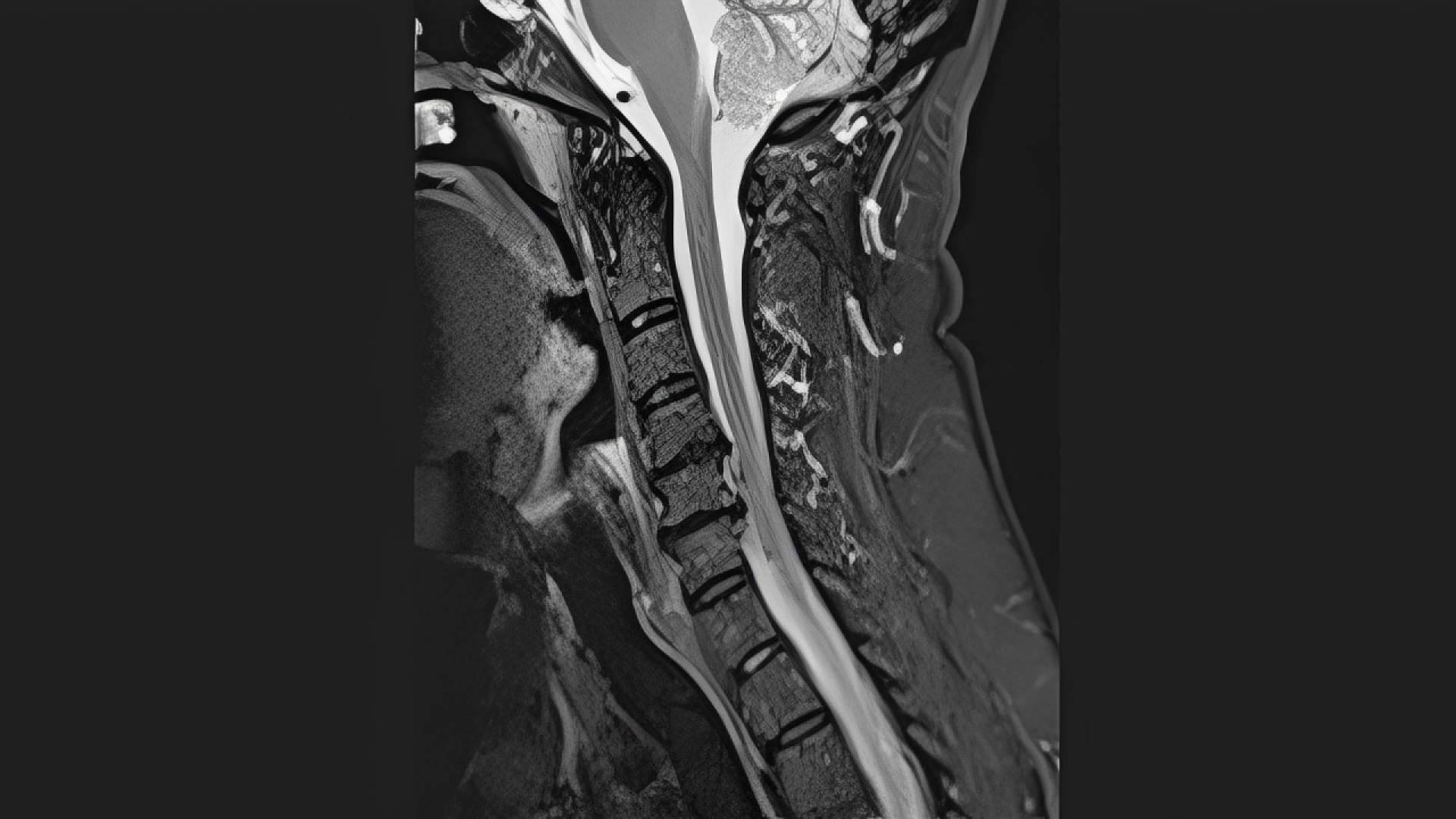 ¿Es posible tratar una hernia cervical sin fusionar las vértebras?